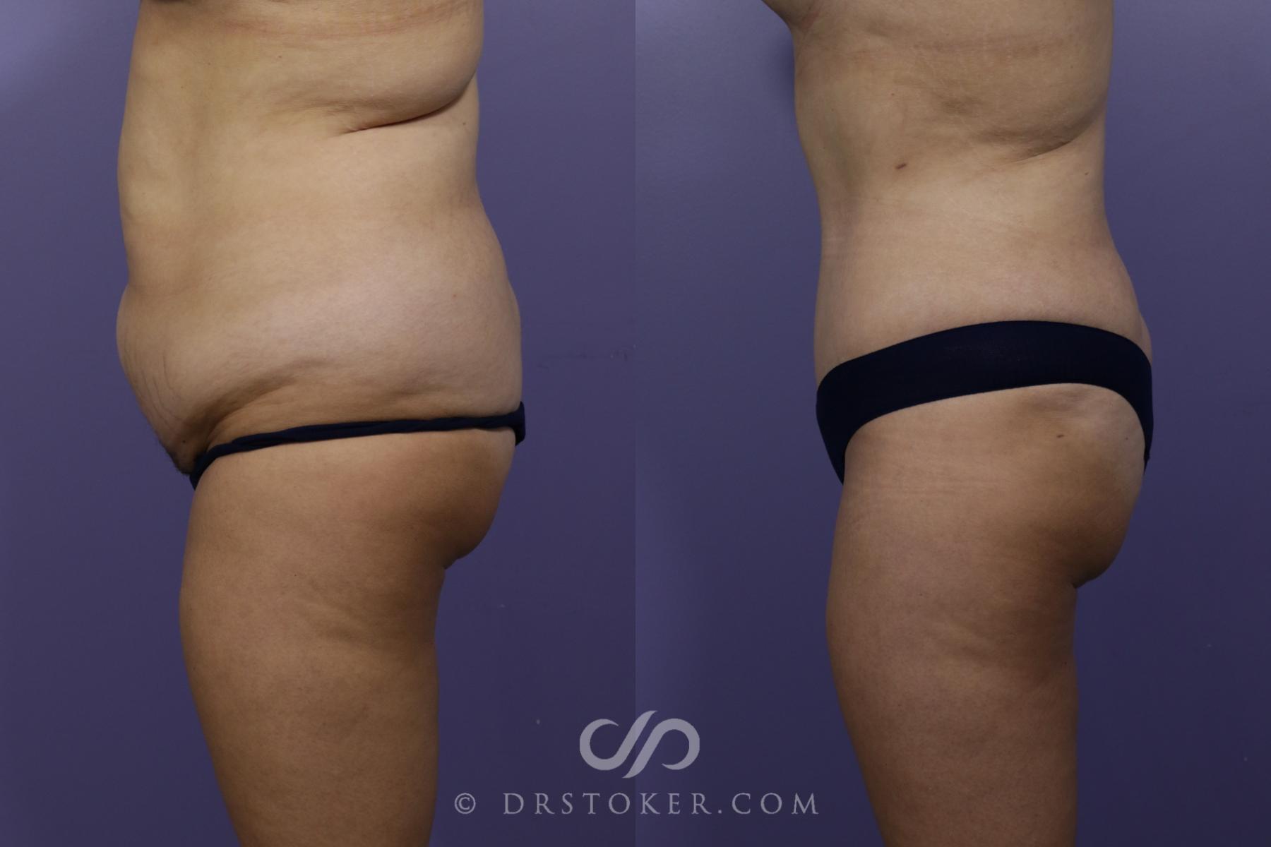 Before & After Tummy Tuck Case 1567 View #4 View in Los Angeles, CA