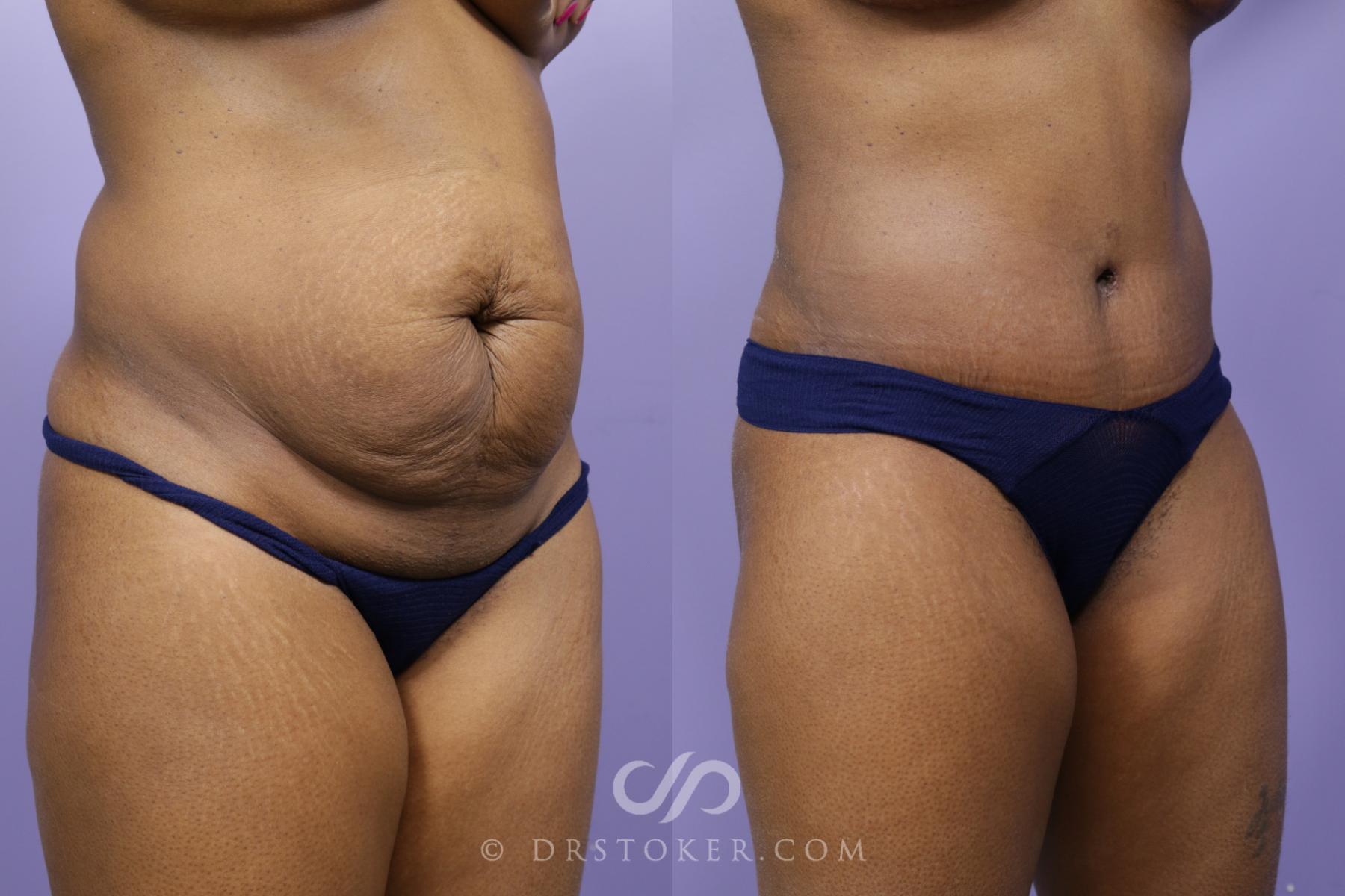 Before & After Tummy Tuck Case 1568 View #2 View in Los Angeles, CA