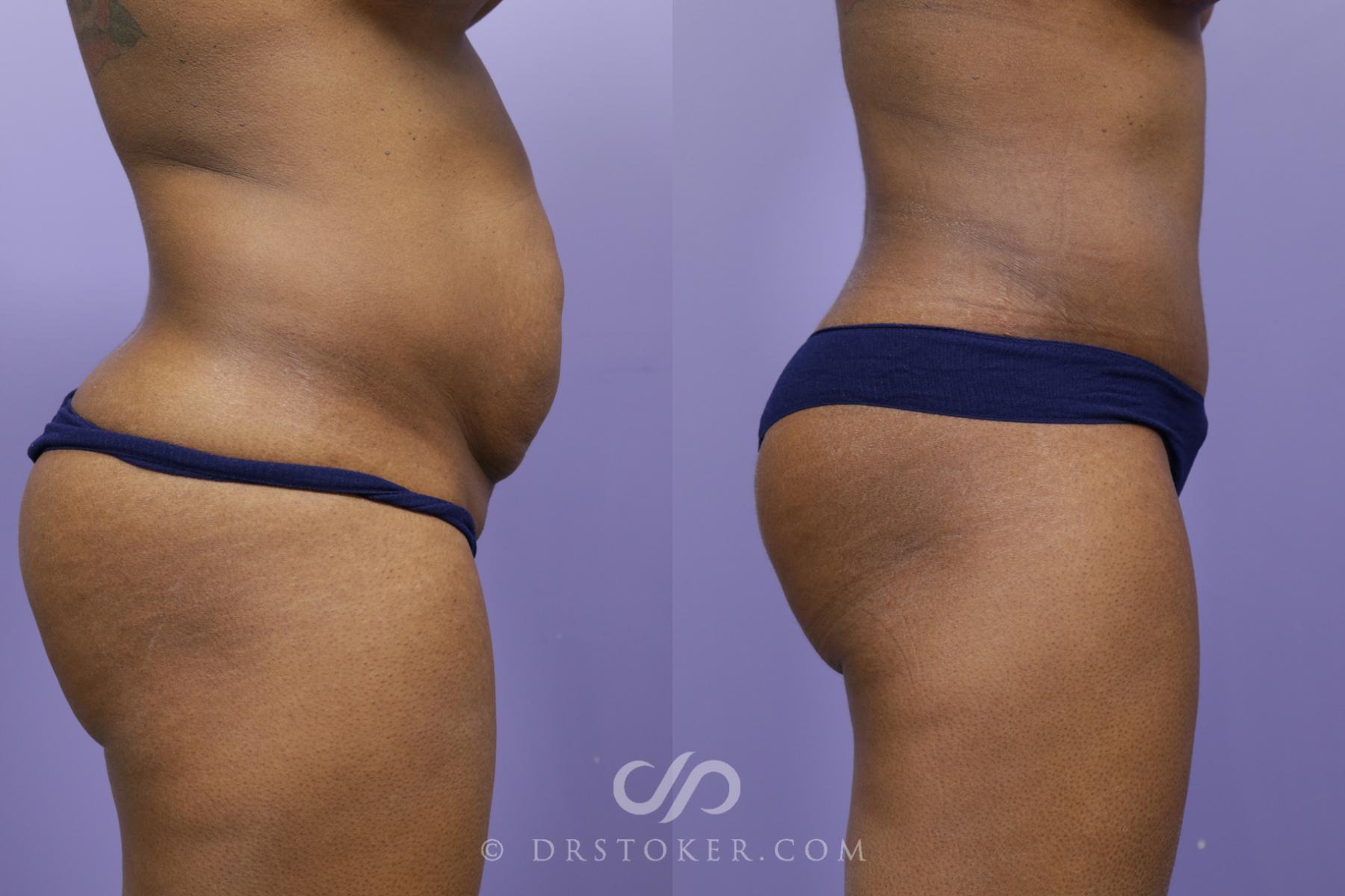 Before & After Tummy Tuck Case 1568 View #3 View in Los Angeles, CA