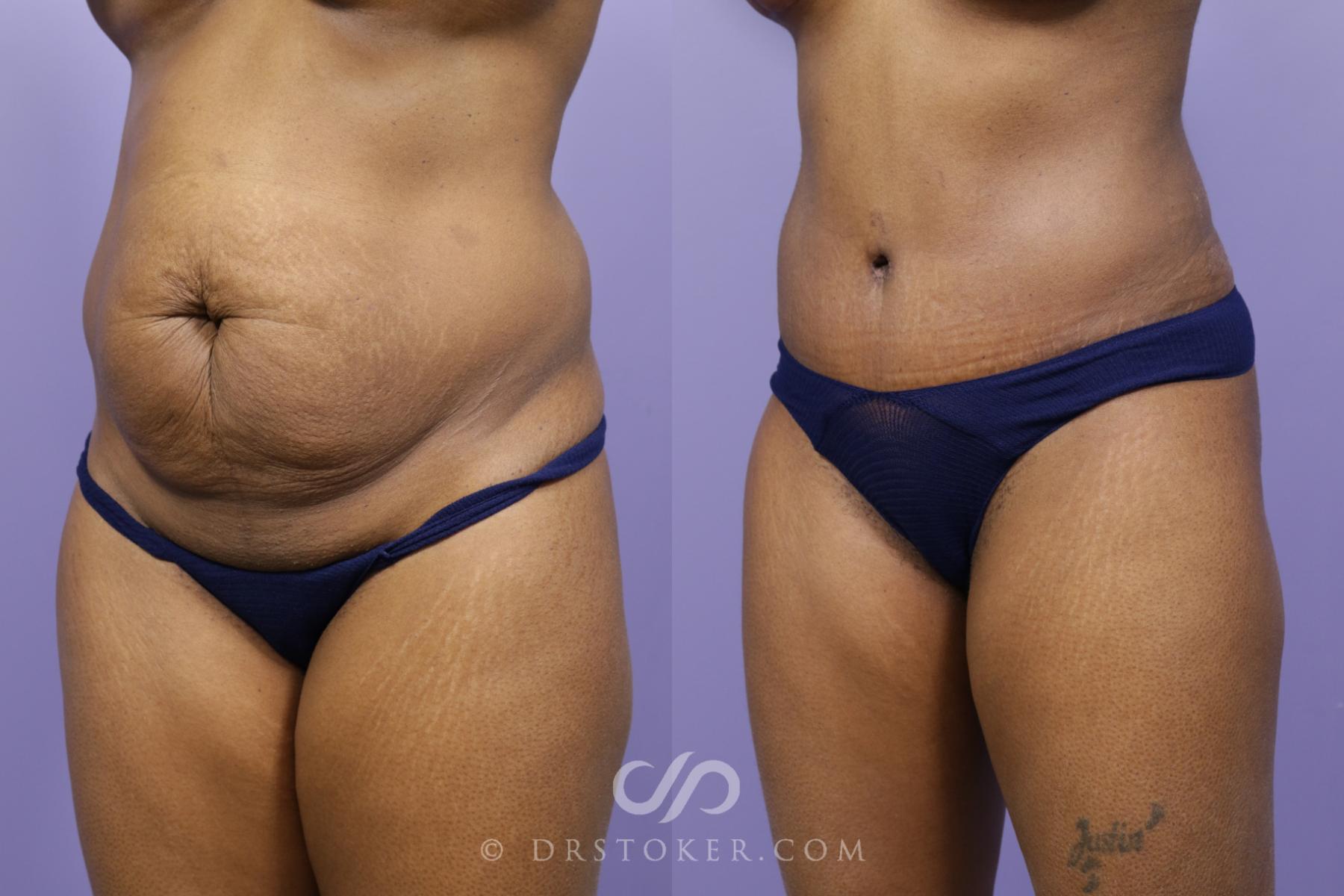Before & After Tummy Tuck Case 1568 View #4 View in Los Angeles, CA