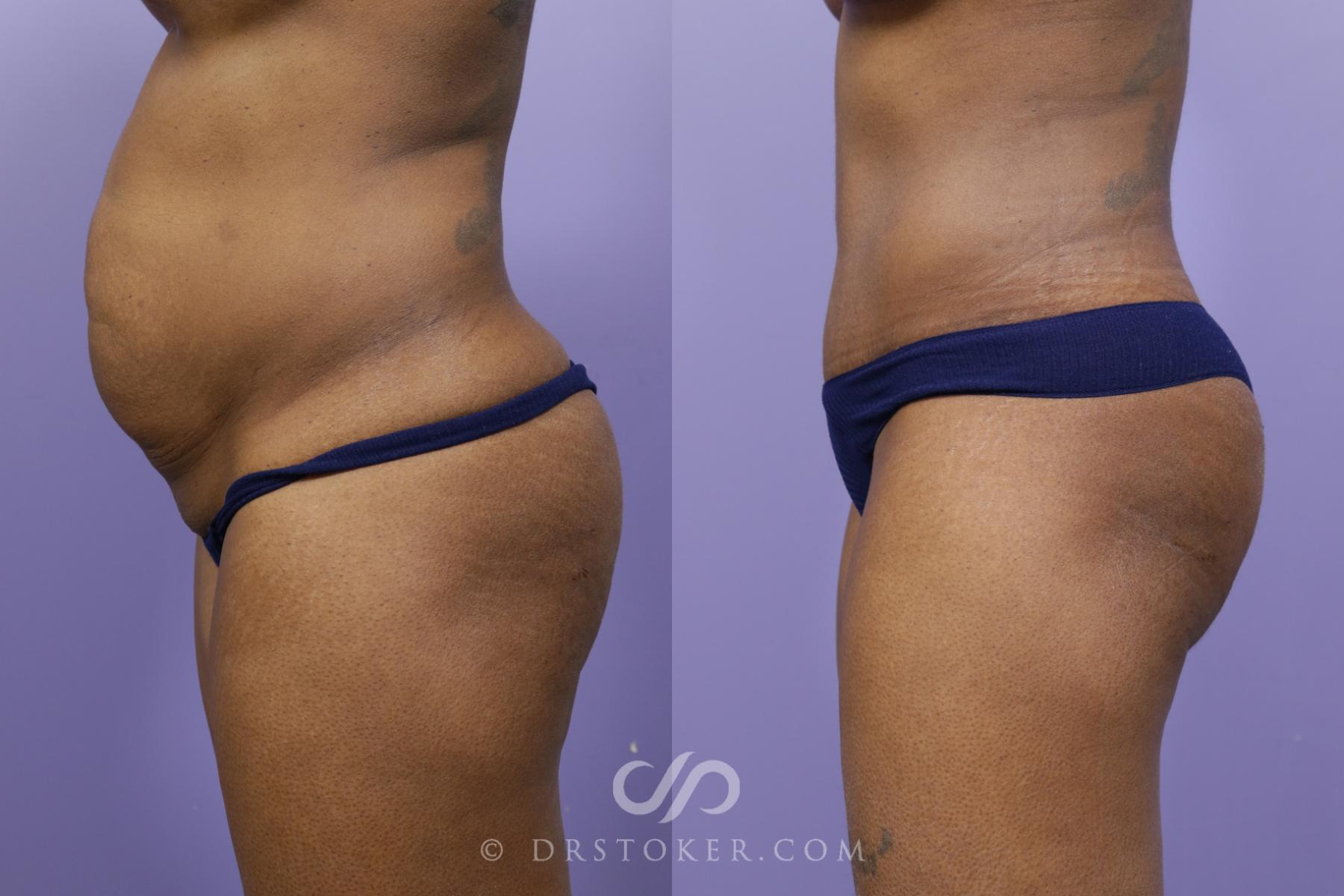Before & After Tummy Tuck Case 1568 View #5 View in Los Angeles, CA