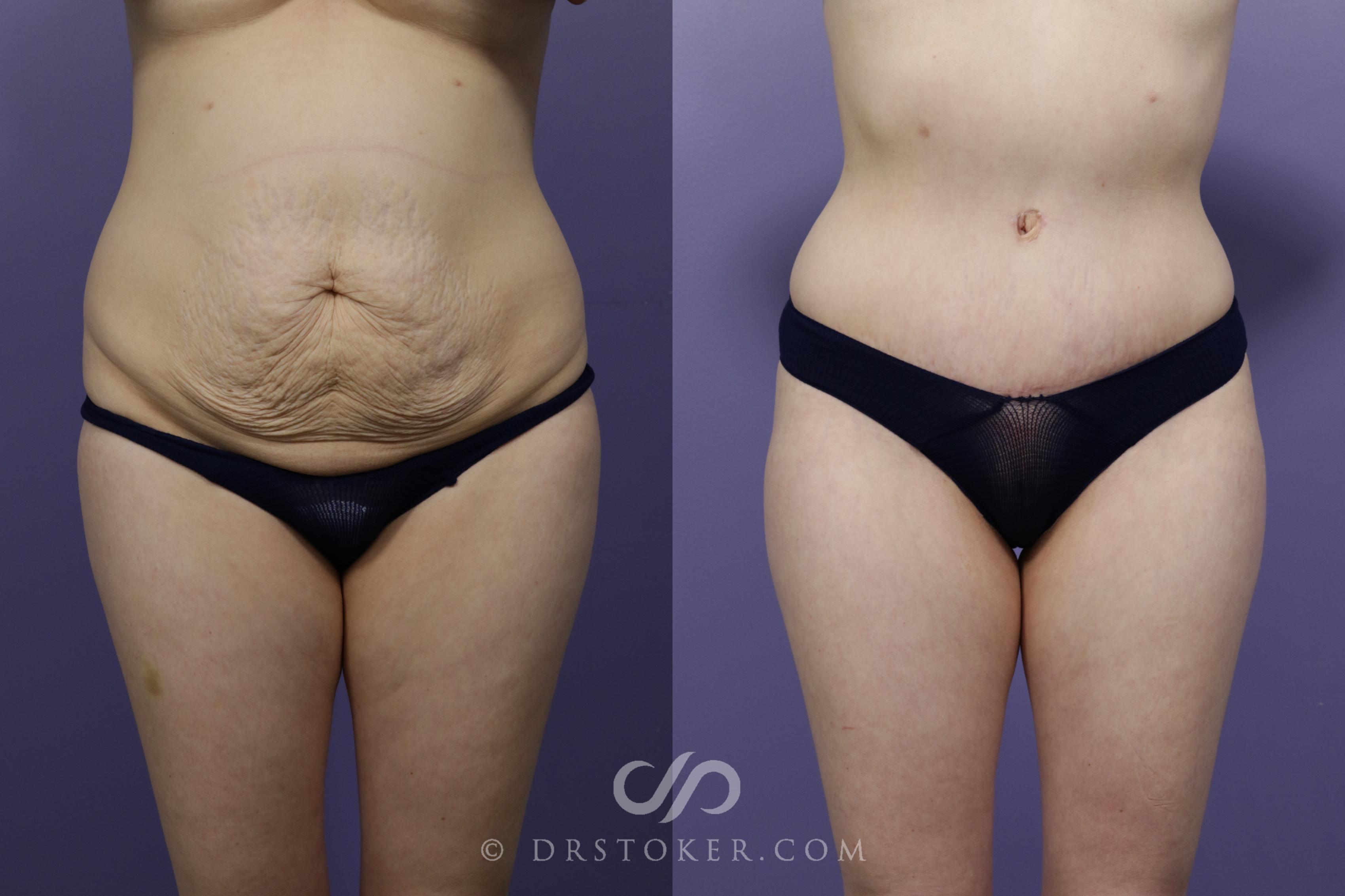 Before & After Tummy Tuck Case 1571 View #1 View in Los Angeles, CA