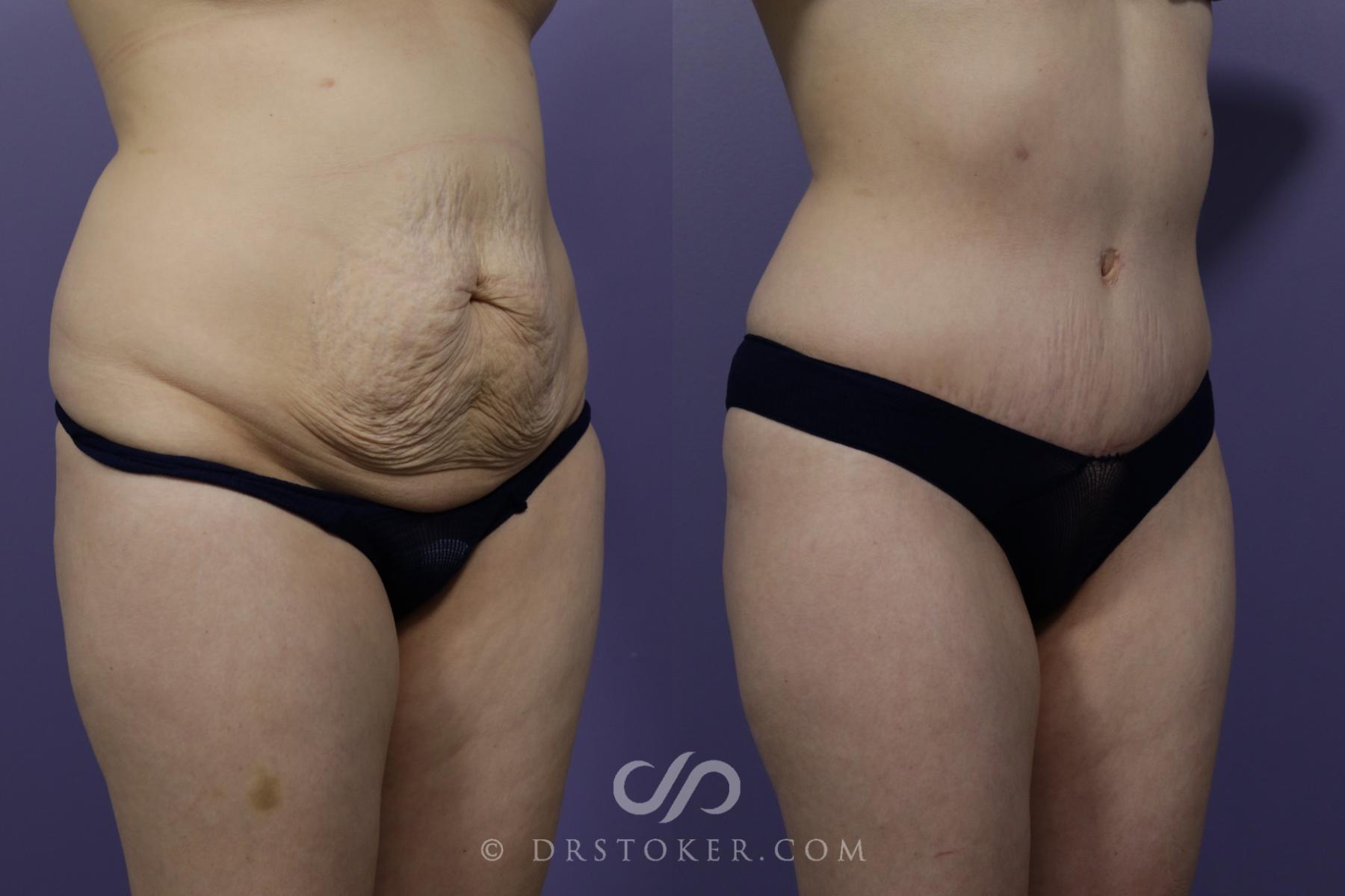 Before & After Tummy Tuck Case 1571 View #2 View in Los Angeles, CA
