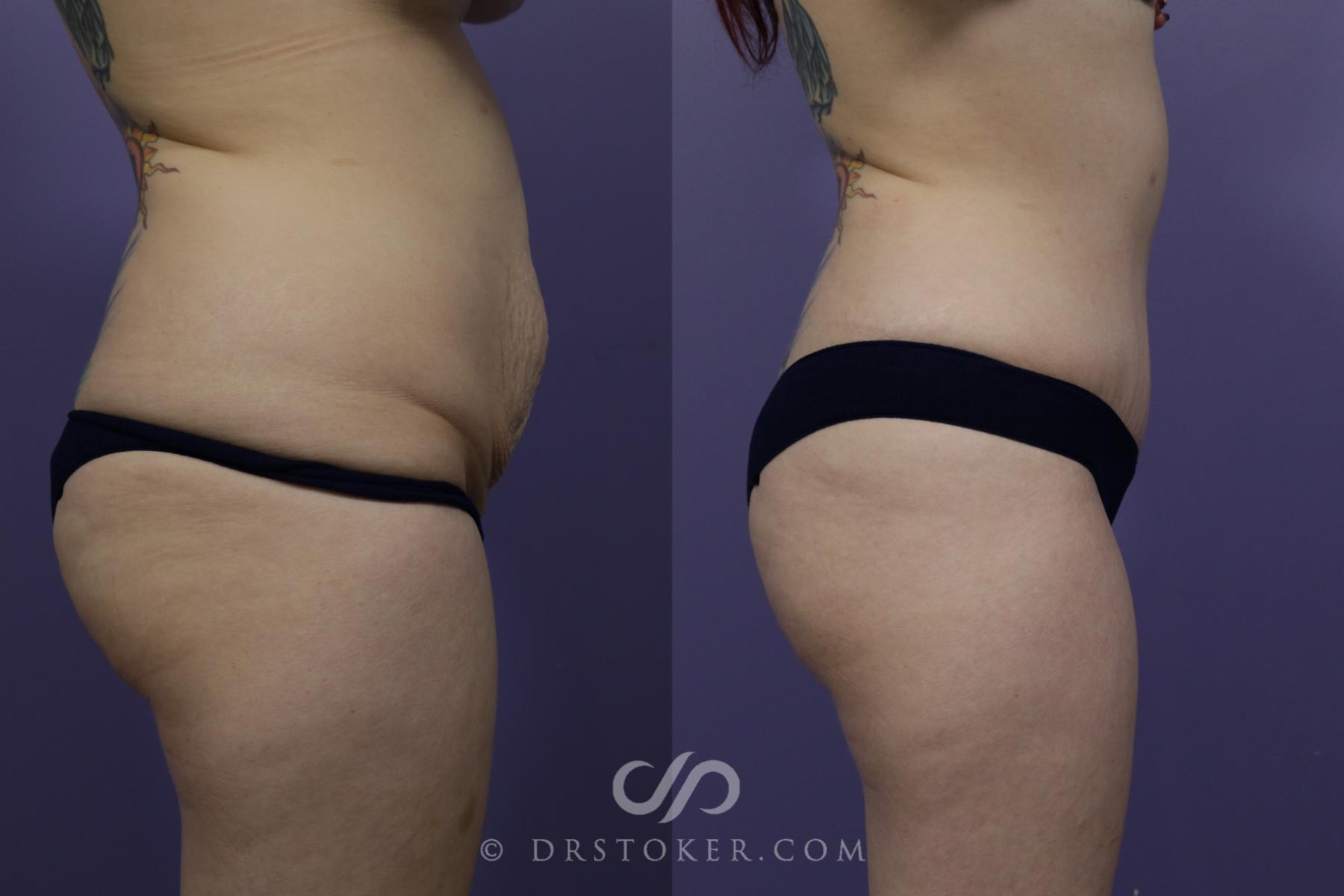 Before & After Tummy Tuck Case 1571 View #3 View in Los Angeles, CA