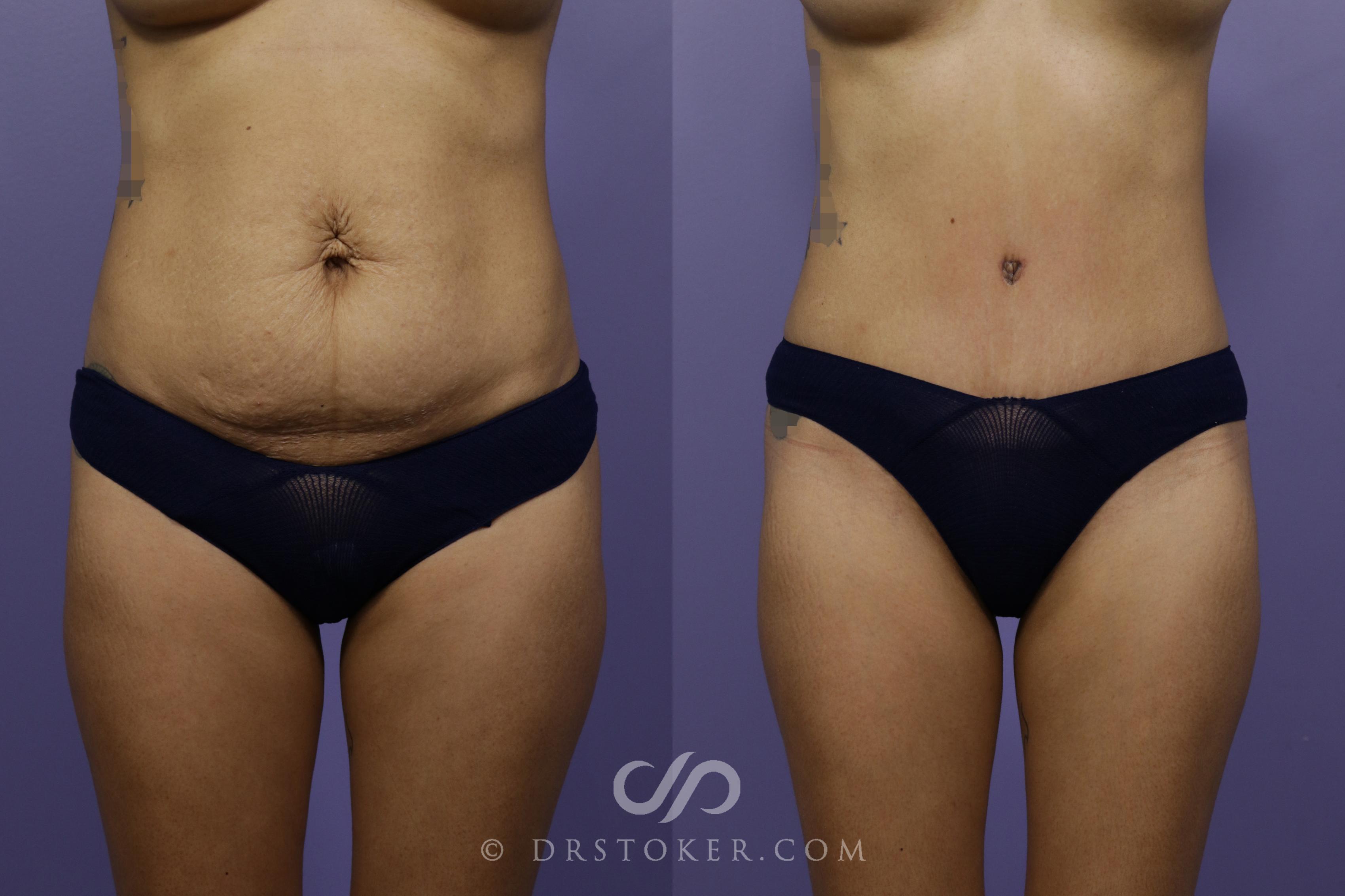 Before & After Tummy Tuck Case 1572 View #1 View in Los Angeles, CA