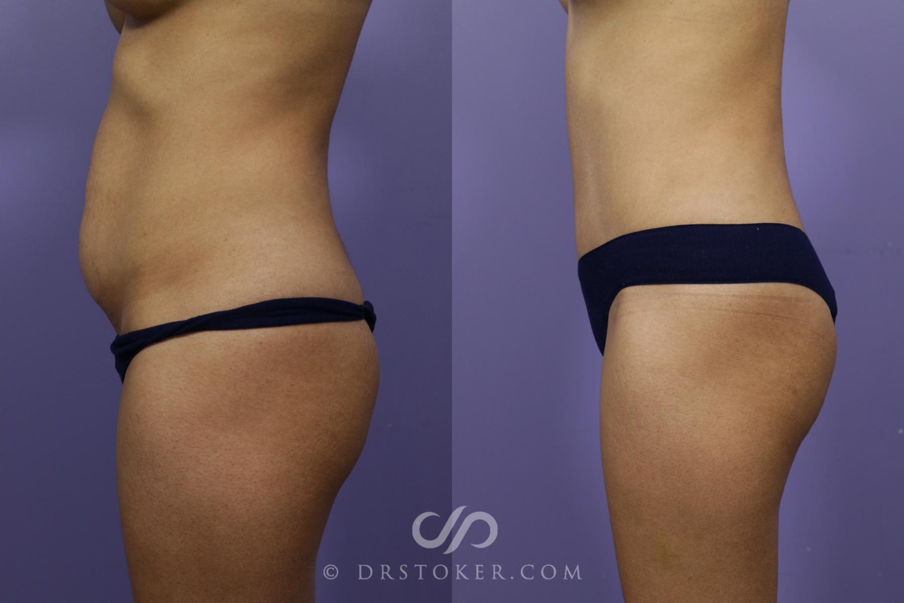 Before & After Tummy Tuck Case 1572 View #2 View in Los Angeles, CA