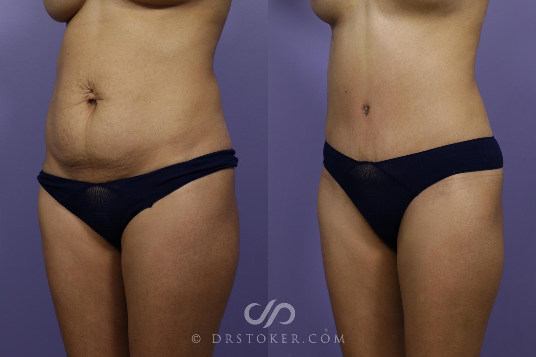 Before & After Tummy Tuck Case 1572 View #3 View in Los Angeles, CA