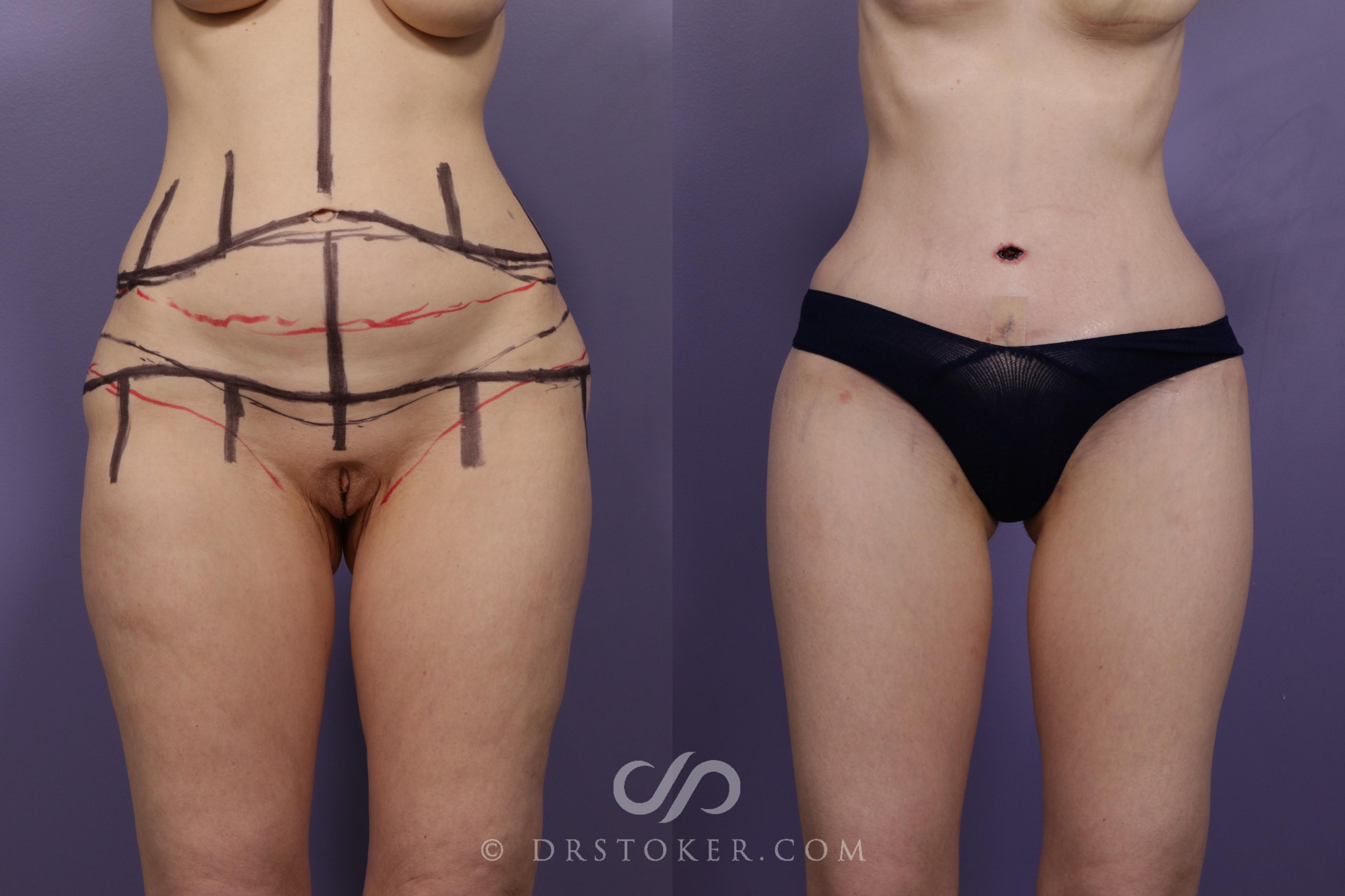 Before & After Tummy Tuck Case 1683 View #1 View in Los Angeles, CA