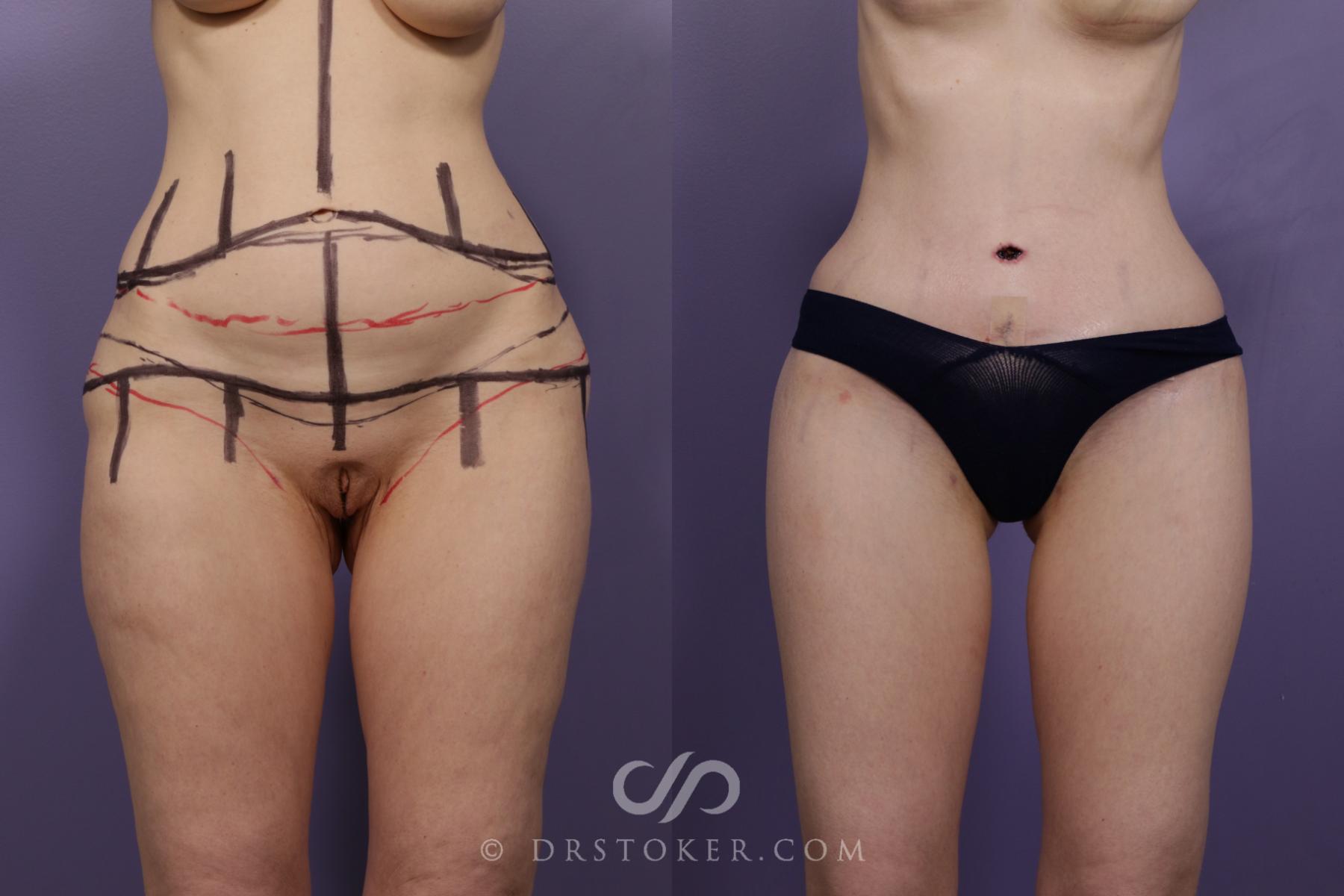 Before & After Body Lift Case 1683 View #1 View in Los Angeles, CA