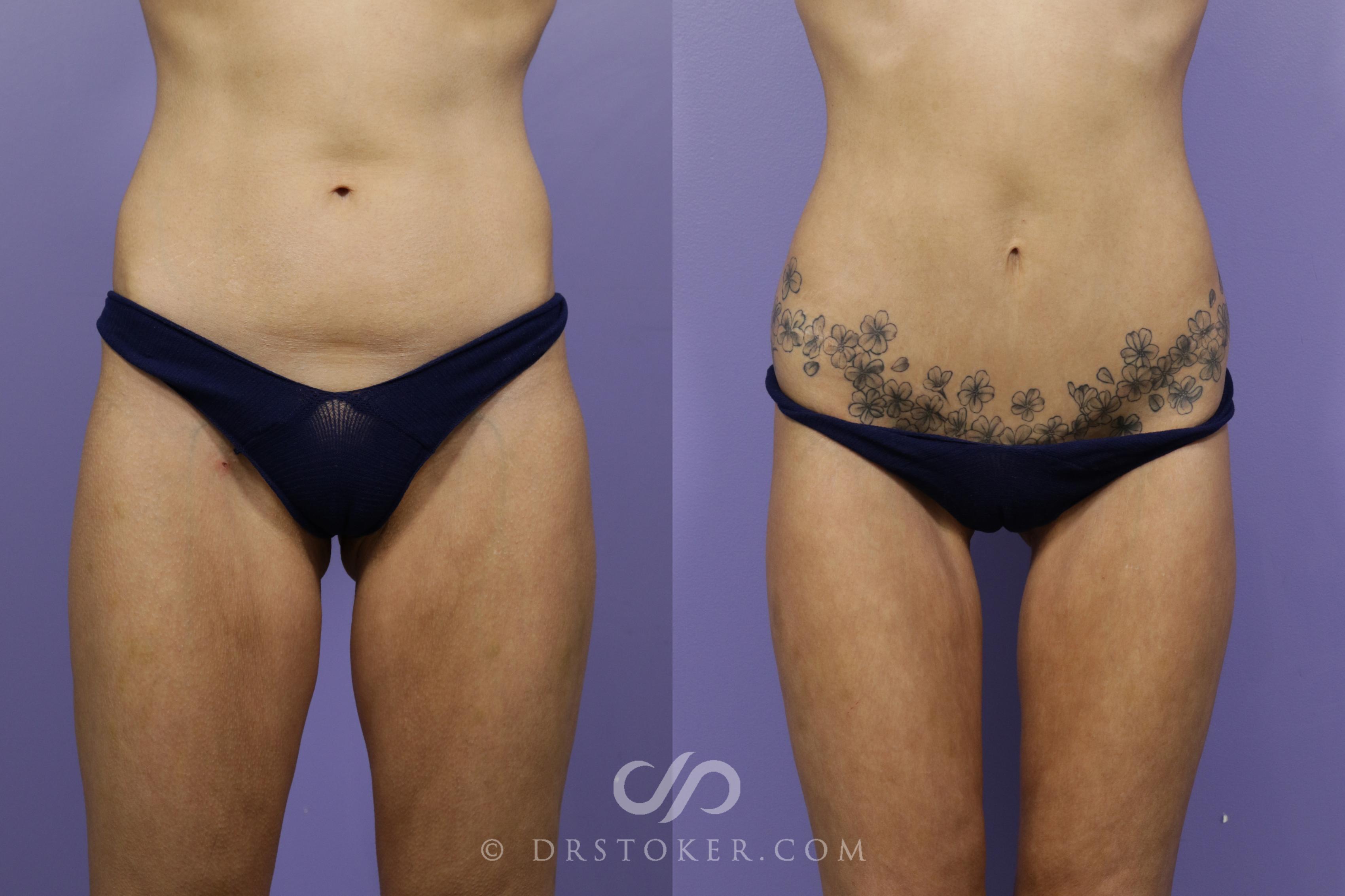 Before & After Tummy Tuck Case 1688 View #1 View in Los Angeles, CA