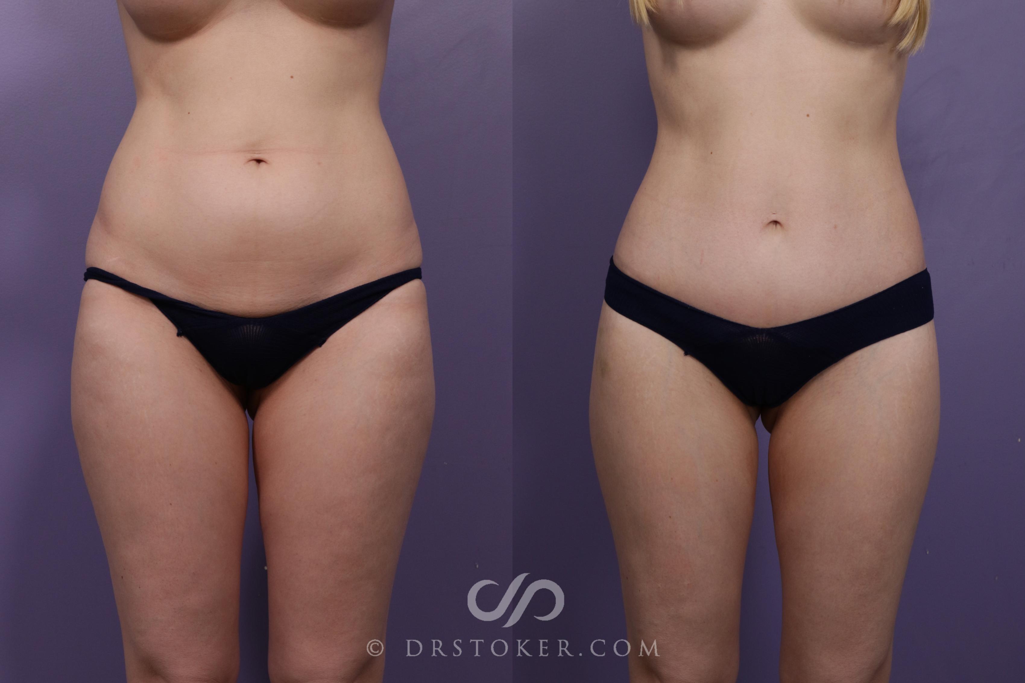 Before & After Tummy Tuck Case 1708 View #1 View in Los Angeles, CA