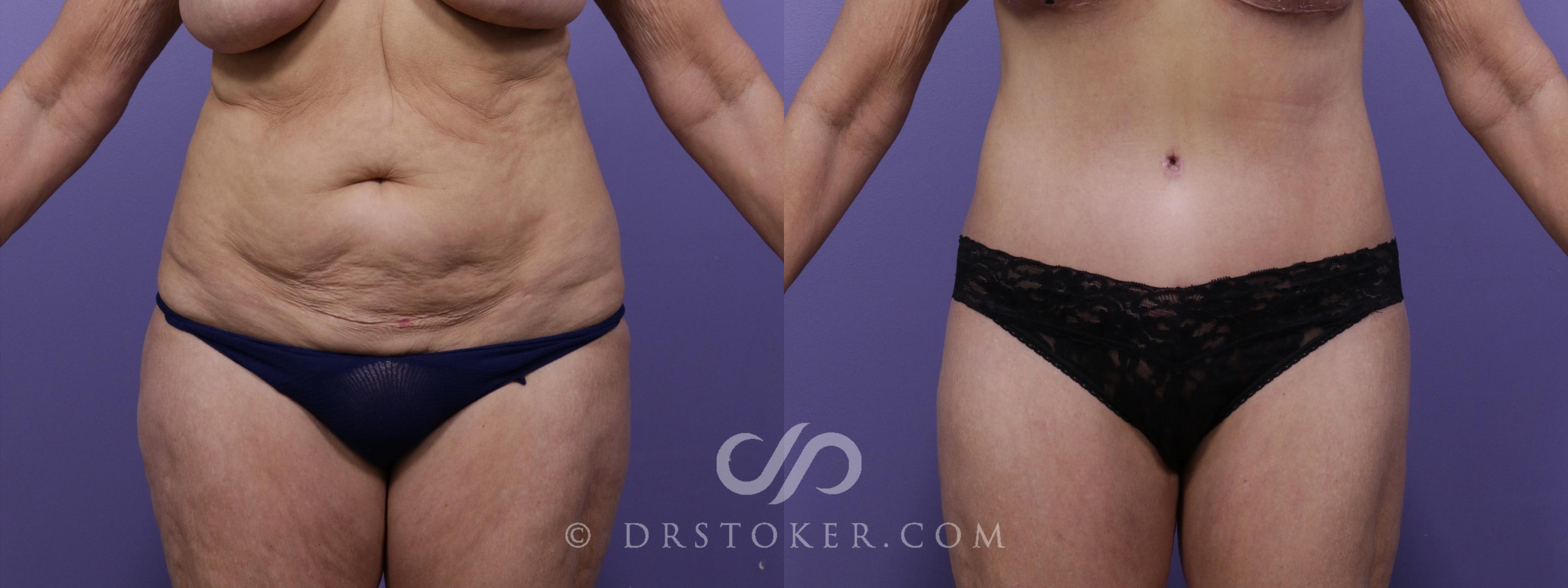 Before & After Tummy Tuck Case 1783 View #1 View in Los Angeles, CA