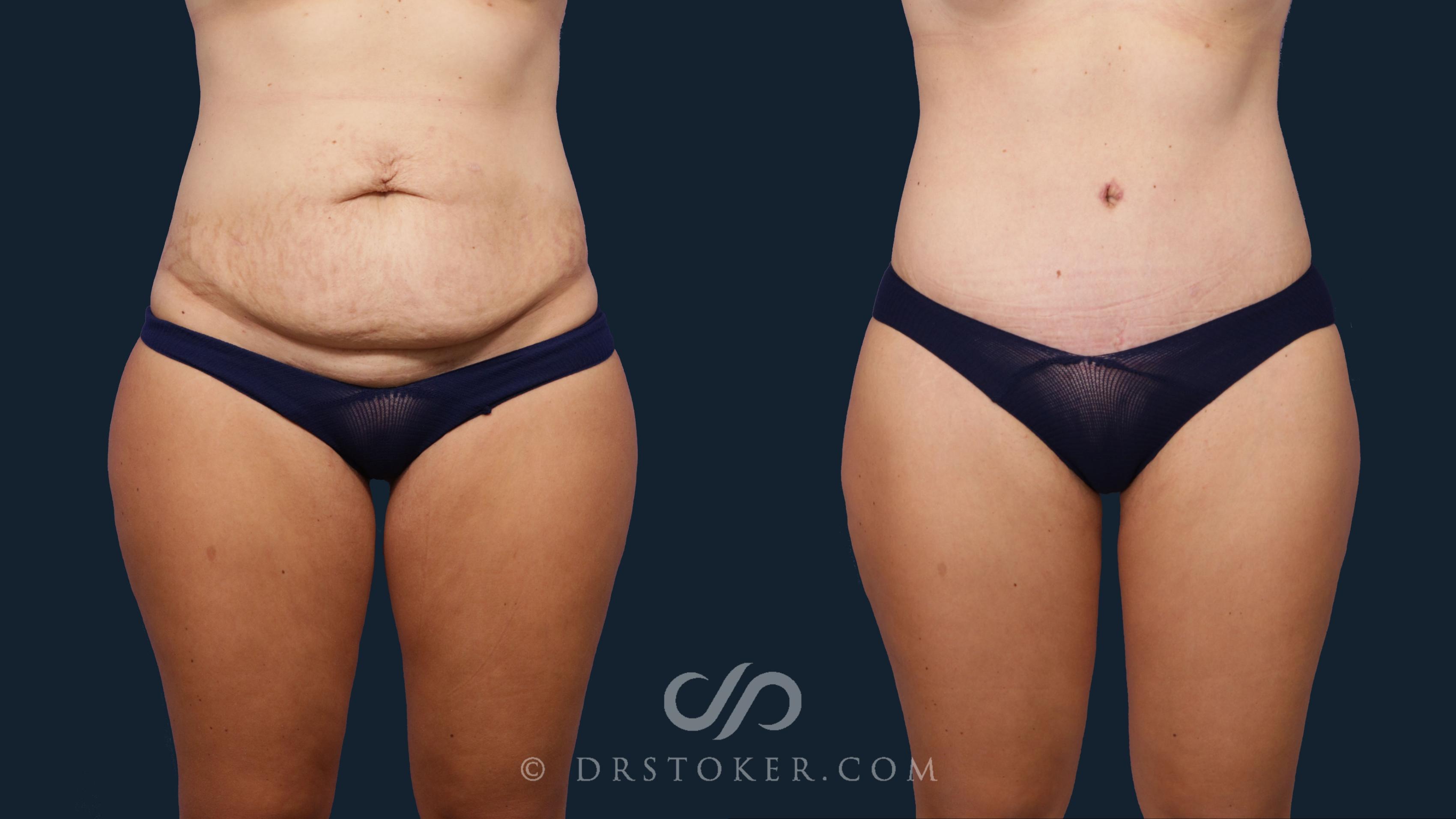 Before & After Tummy Tuck Case 1797 Front View in Los Angeles, CA