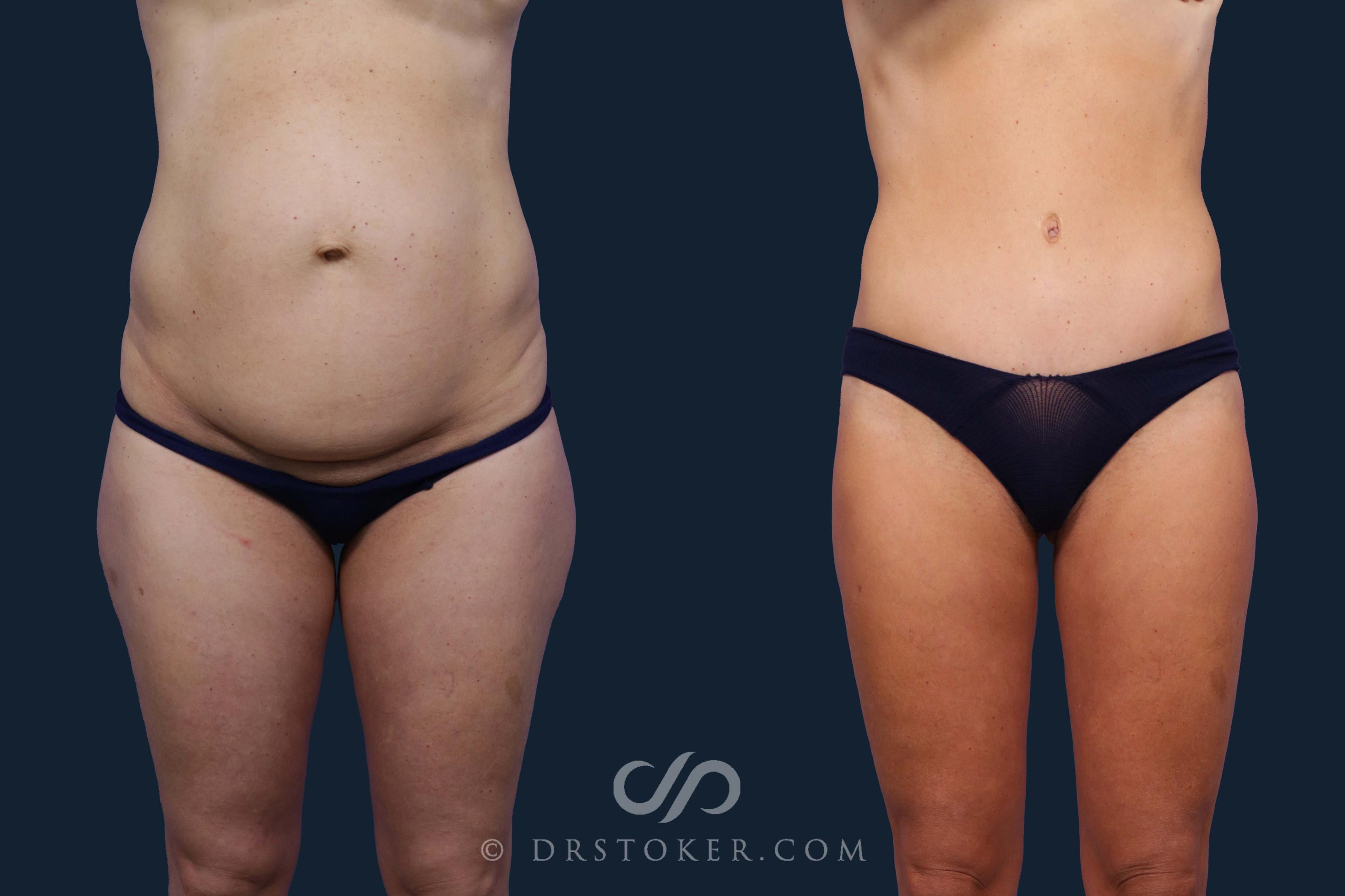 Before & After Tummy Tuck Case 1944 Front View in Los Angeles, CA