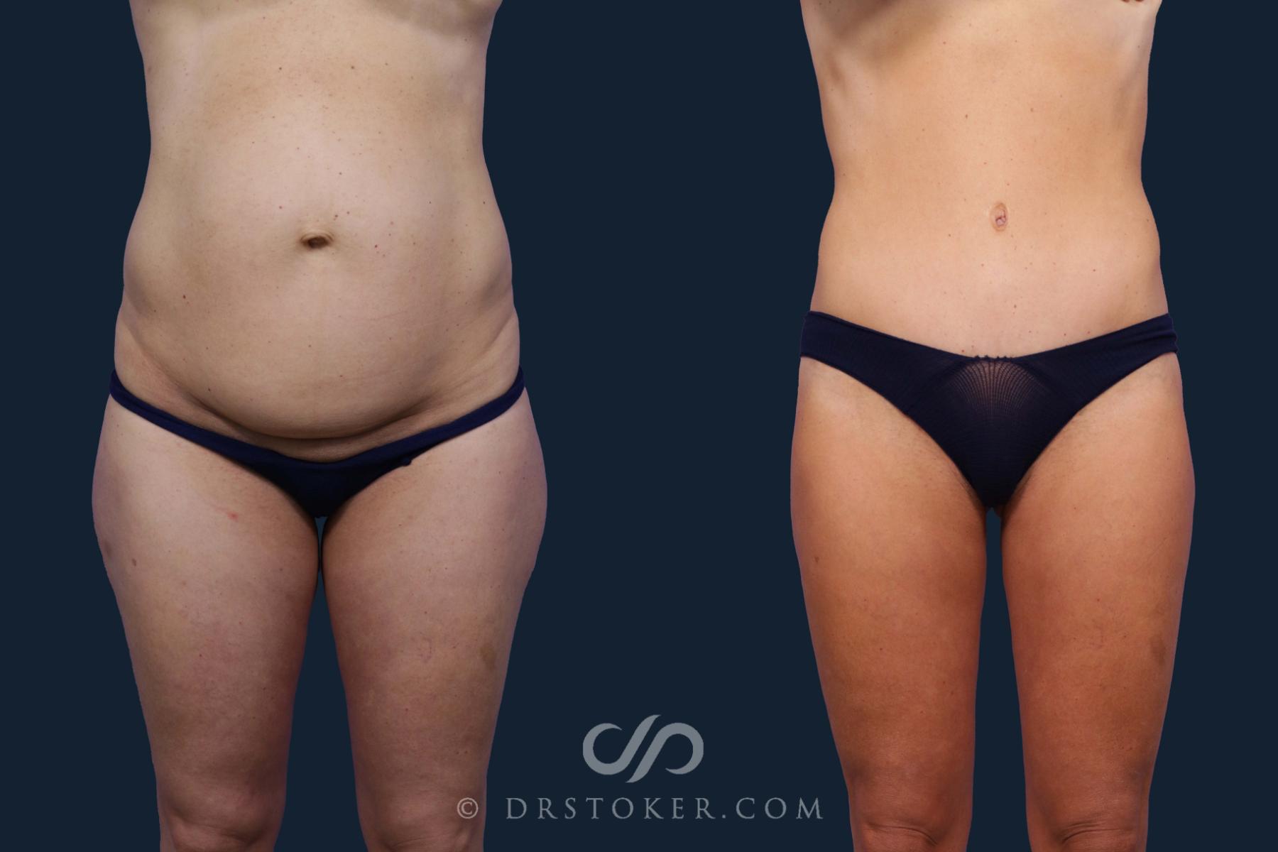 Before & After Tummy Tuck Case 1944 Front View in Los Angeles, CA