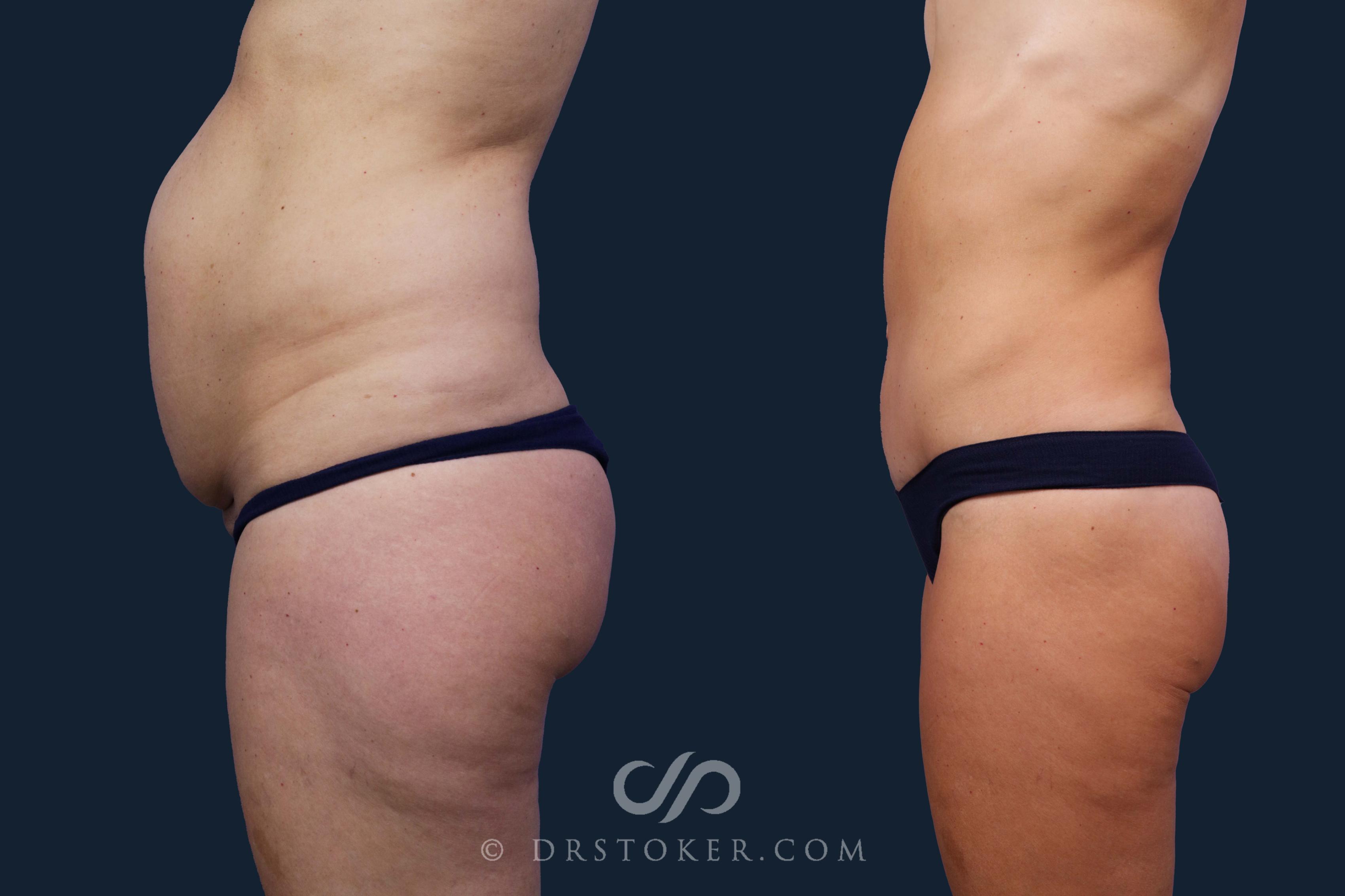 Before & After Tummy Tuck Case 1945 Left Side View in Los Angeles, CA