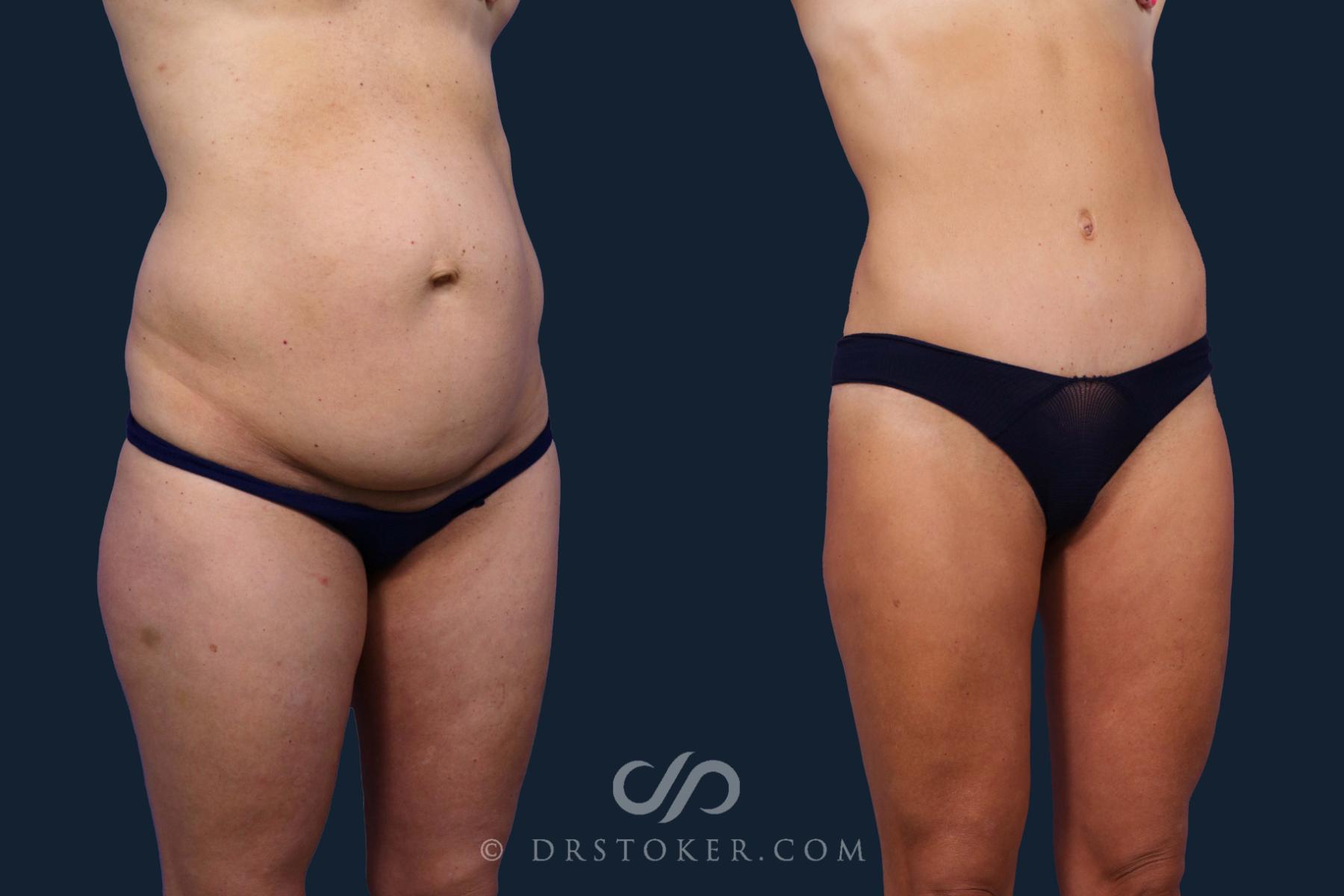 Before & After Tummy Tuck Case 1946 Right Oblique View in Los Angeles, CA