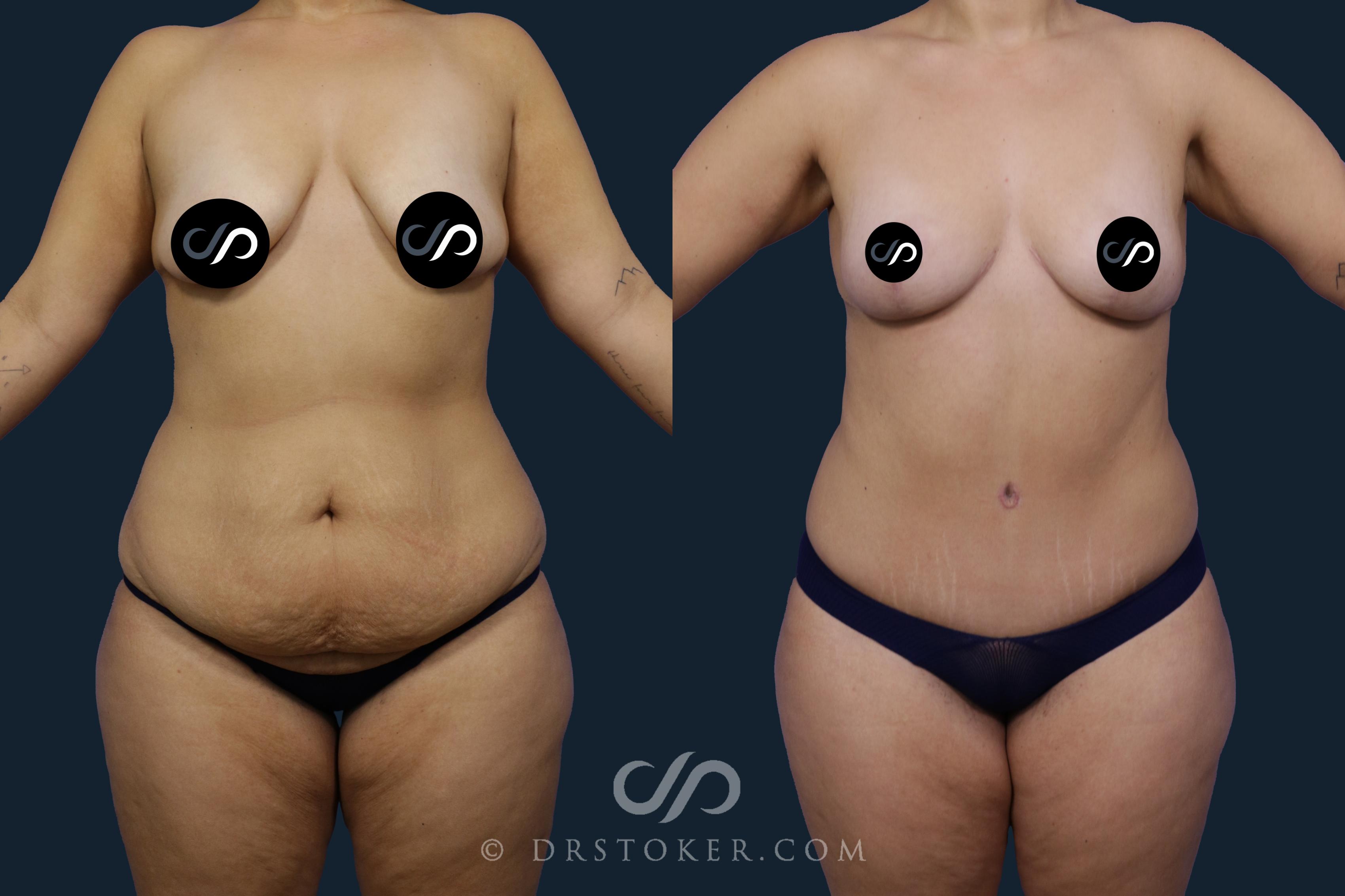 Before & After Tummy Tuck Case 1989 Front View in Los Angeles, CA