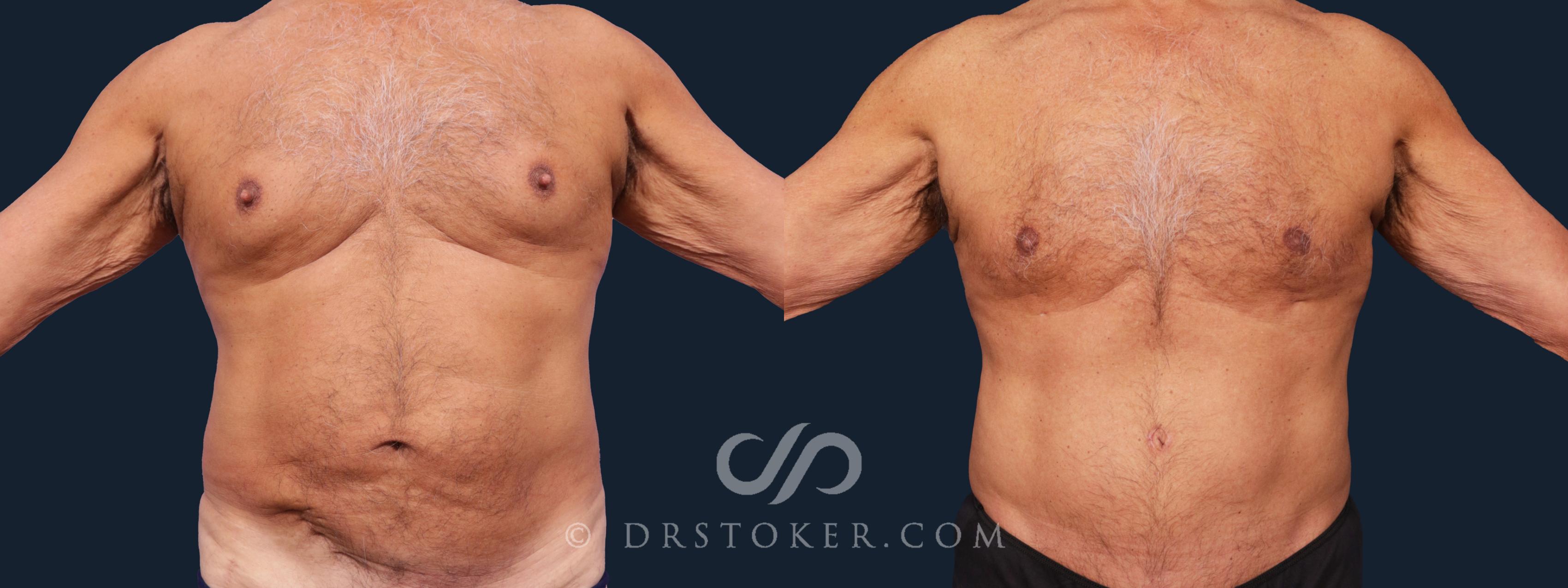 Before & After Tummy Tuck Case 2006 Front View in Los Angeles, CA