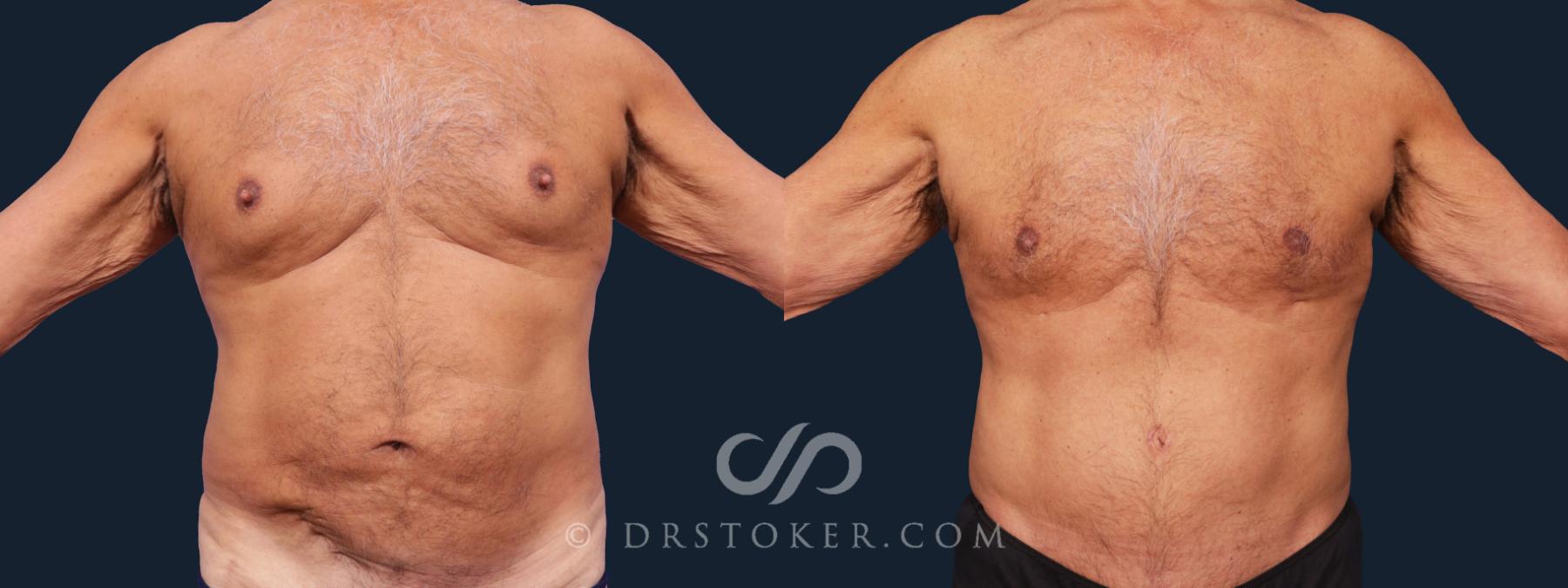 Before & After Tummy Tuck for Men Case 2006 Front View in Los Angeles, CA