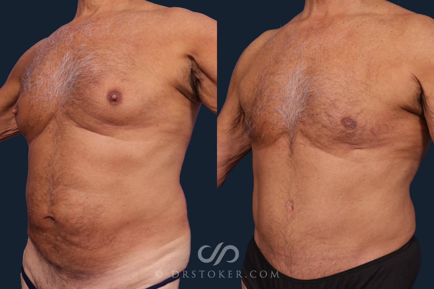 Before & After Tummy Tuck Case 2006 Left Oblique View in Los Angeles, CA