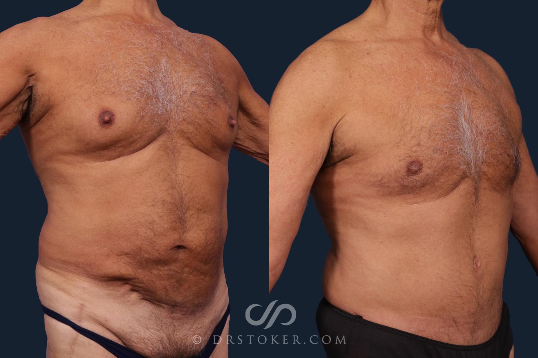 Before & After Tummy Tuck for Men Case 2006 Right Oblique View in Los Angeles, CA