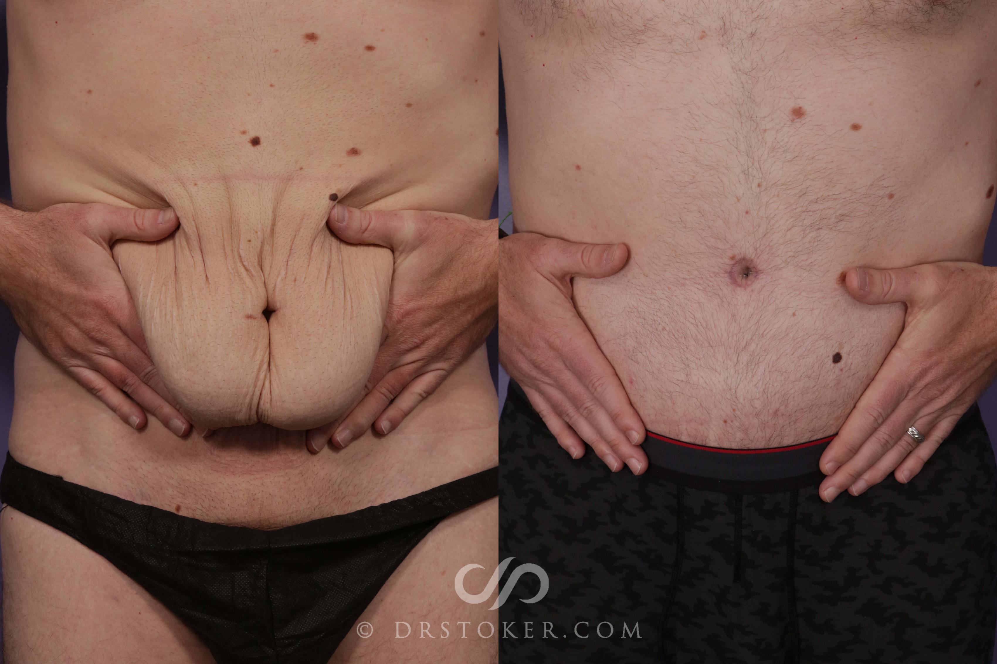 Before & After Tummy Tuck Case 2014 Front View in Los Angeles, CA