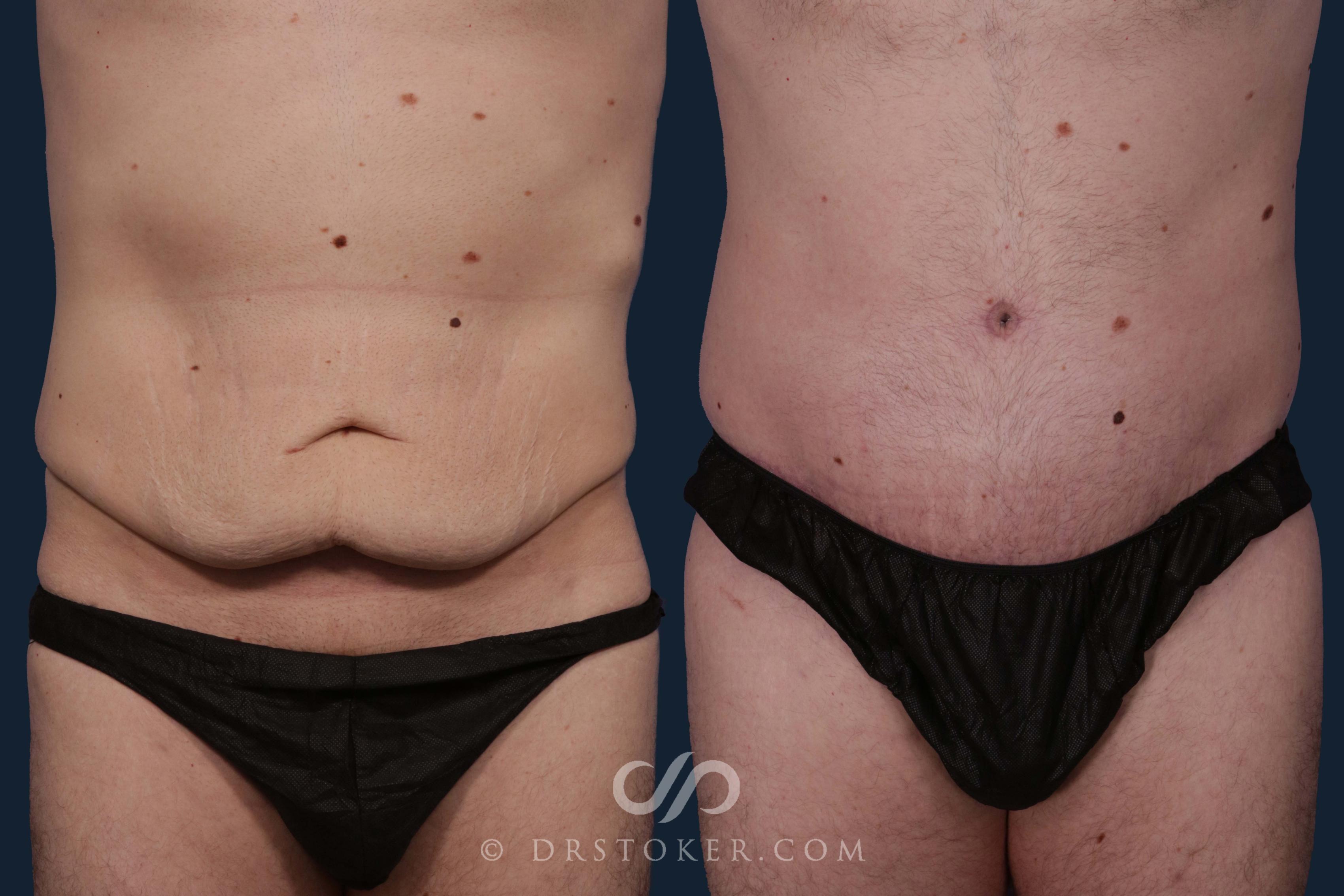 Before & After Tummy Tuck Case 2015 Front View in Los Angeles, CA