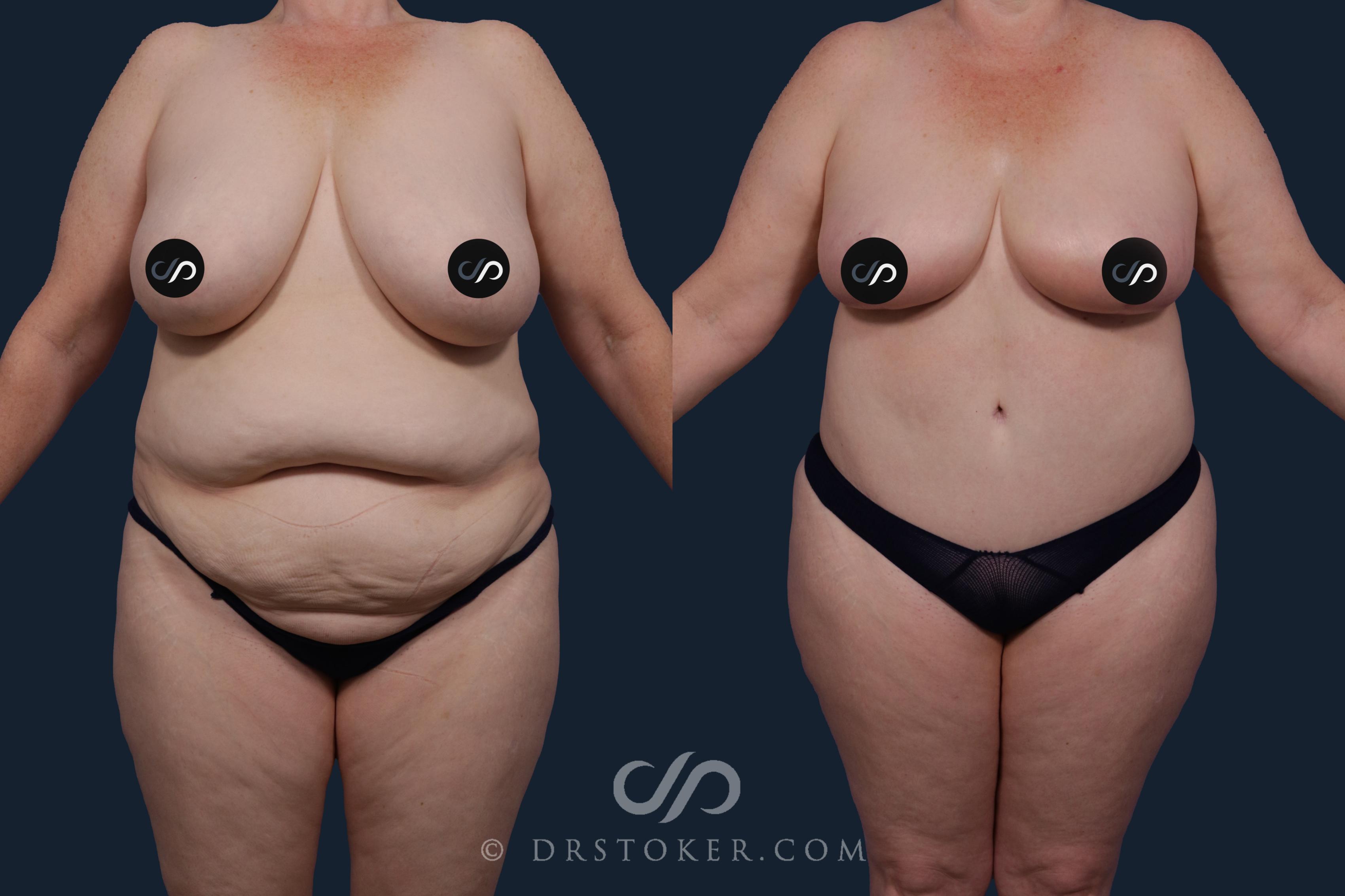 Before & After Body Lift Case 2043 Front View in Los Angeles, CA