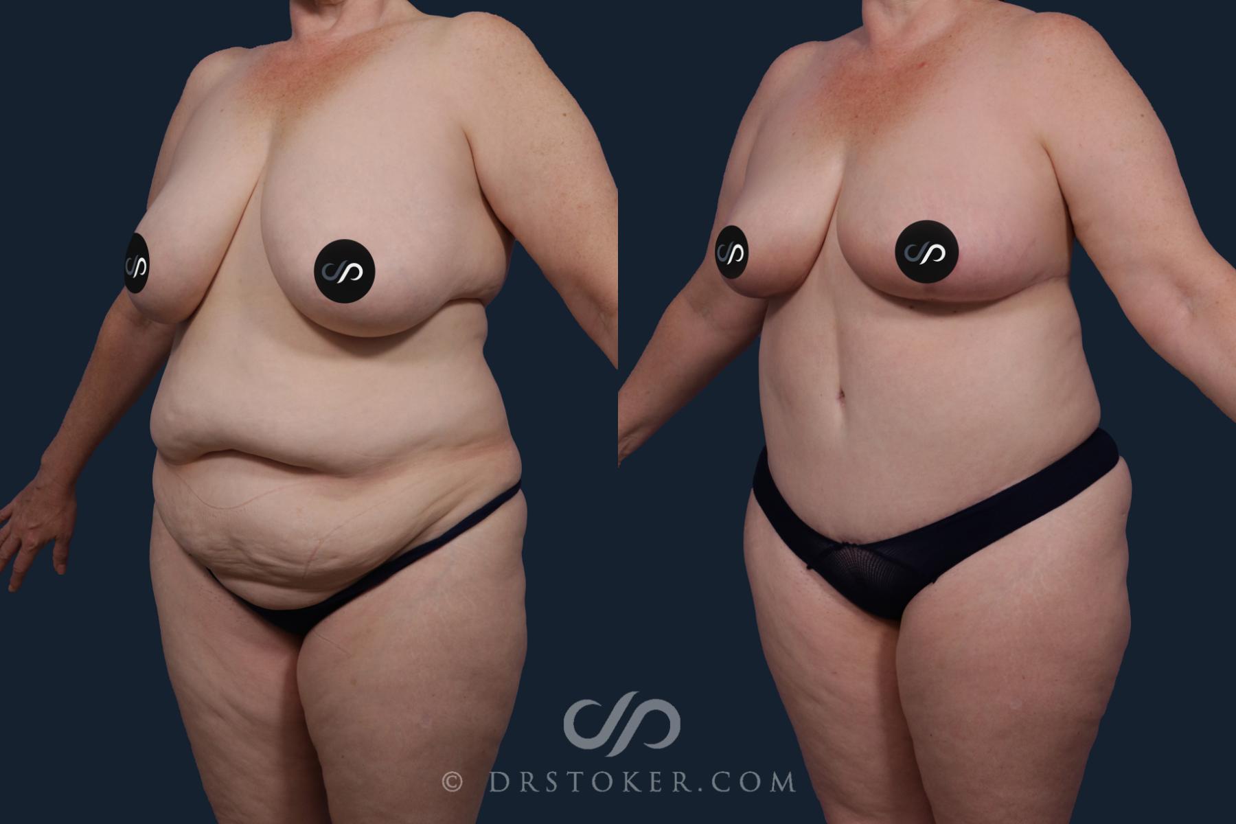 Before & After Tummy Tuck Case 2043 Left Oblique View in Los Angeles, CA