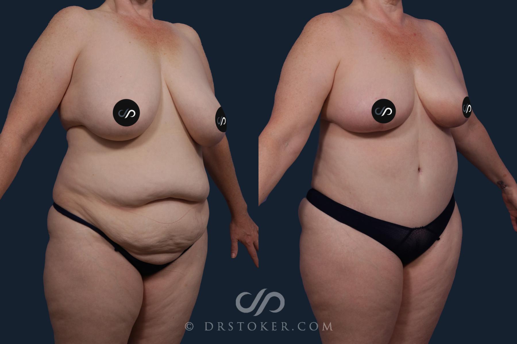 Before & After Body Lift Case 2043 Right Oblique View in Los Angeles, CA