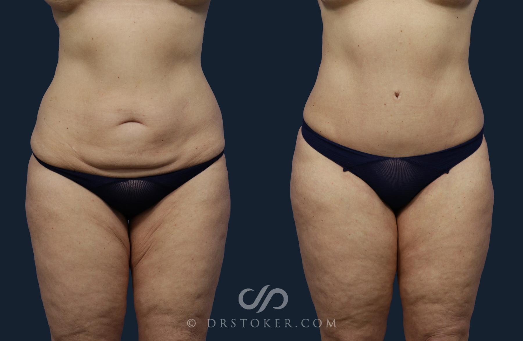 Before & After Tummy Tuck Case 2046 Front View in Los Angeles, CA