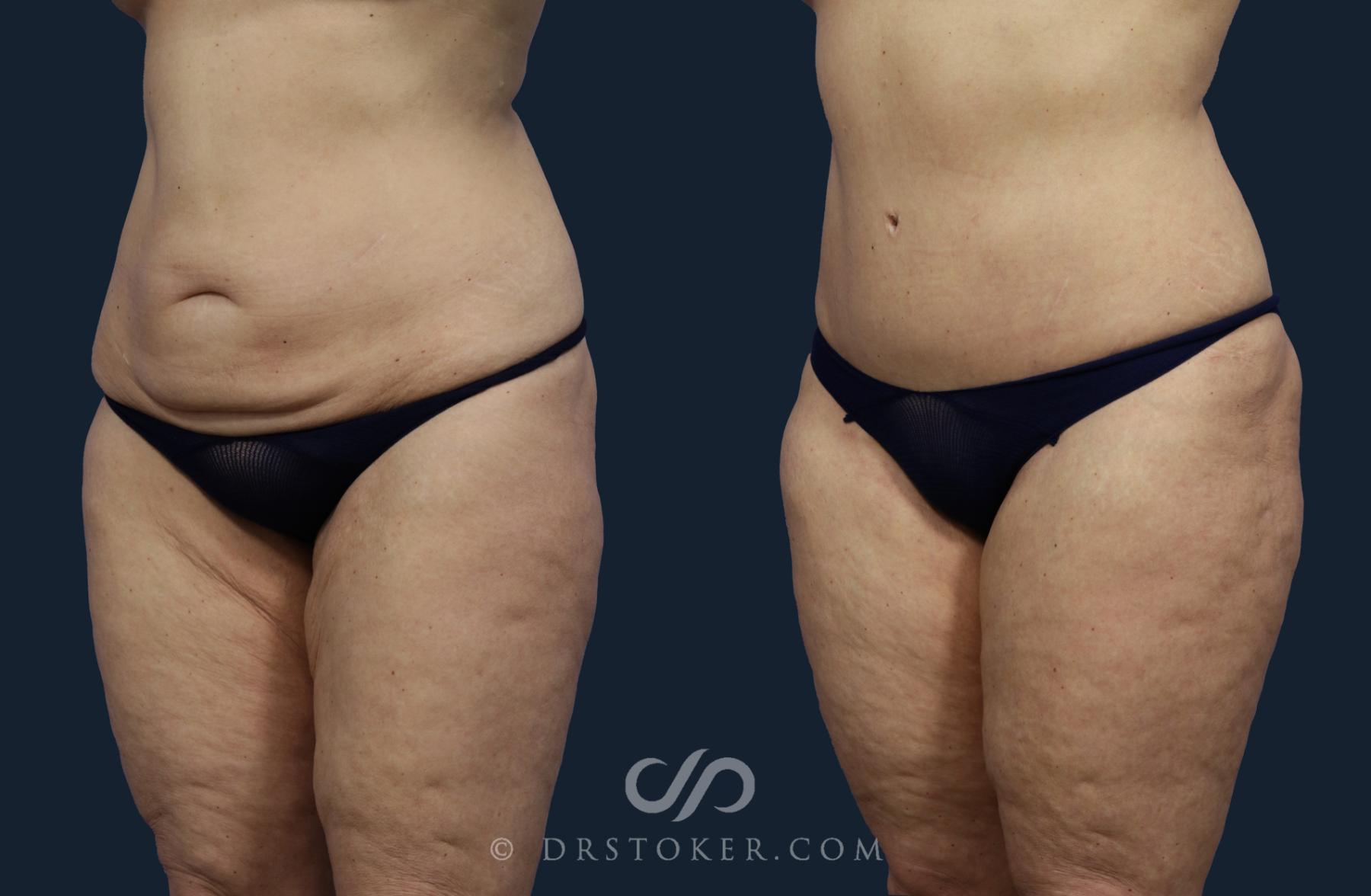 Before & After Tummy Tuck Case 2046 Left Oblique View in Los Angeles, CA
