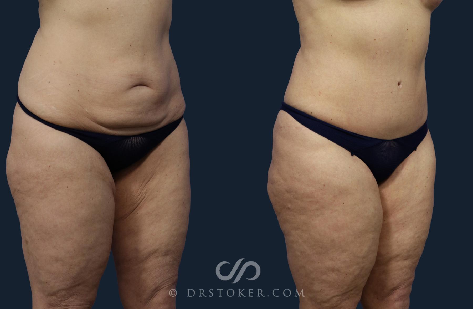 Before & After Tummy Tuck Case 2046 Right Oblique View in Los Angeles, CA