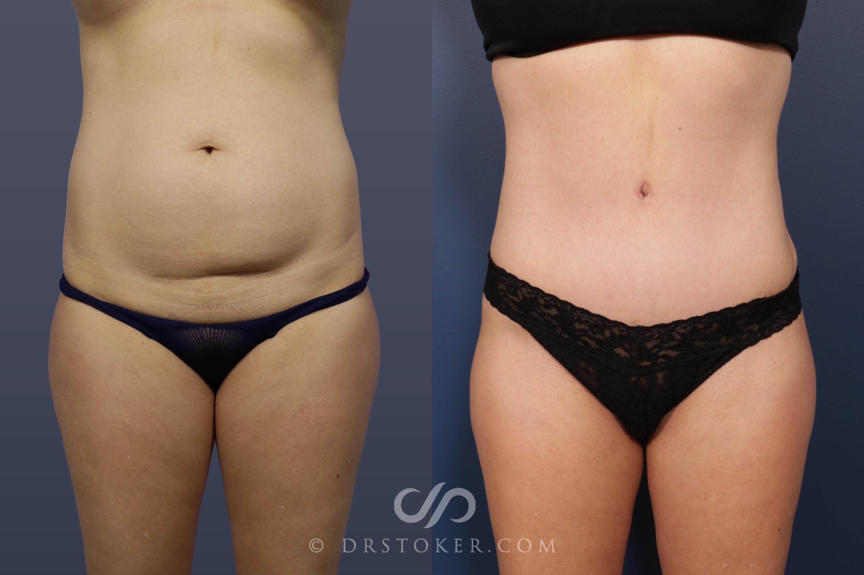 Before & After Liposuction Case 2056 Front View in Los Angeles, CA