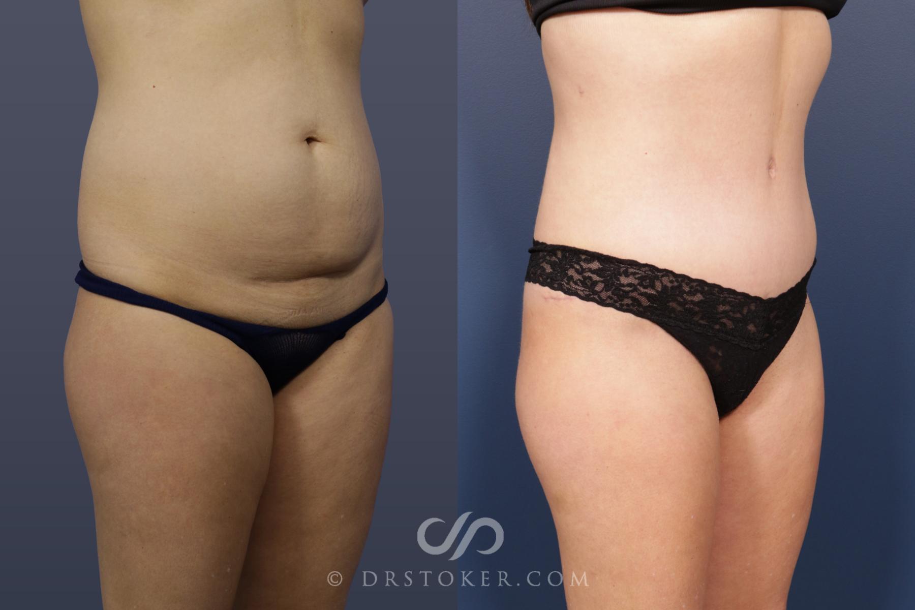 Before & After Tummy Tuck Case 2056 Right Oblique View in Los Angeles, CA