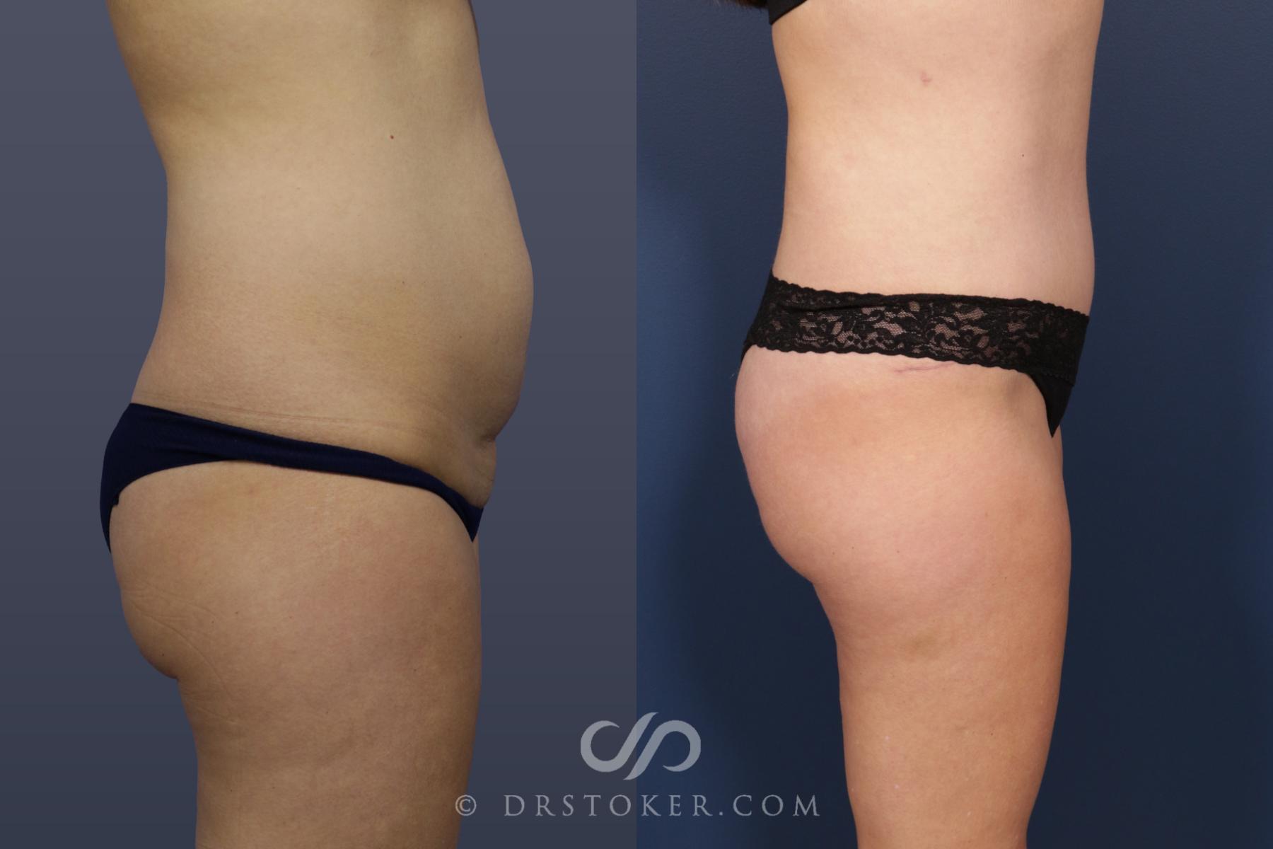 Before & After Liposuction Case 2056 Right Side View in Los Angeles, CA