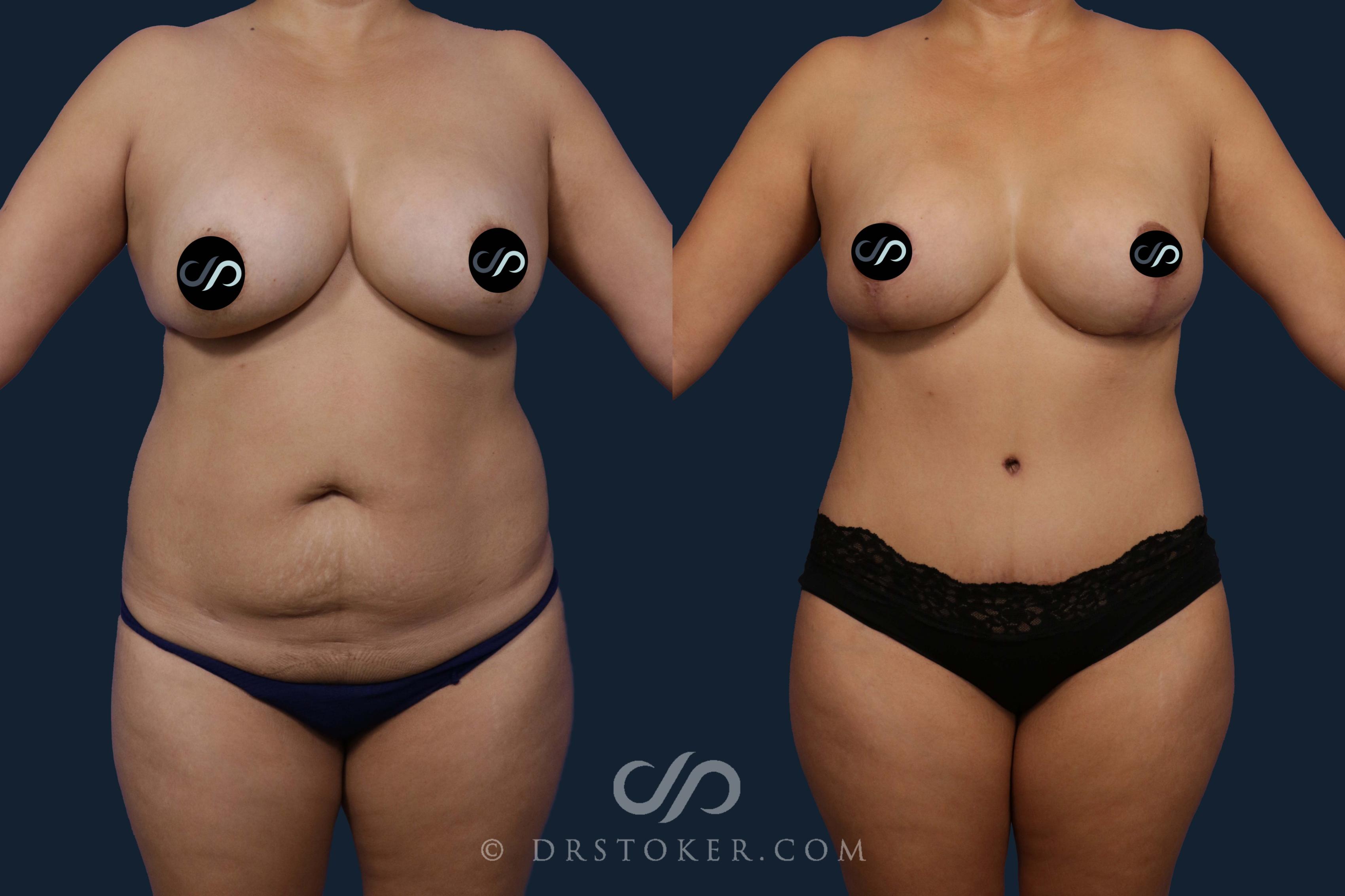 Before & After Mommy Makeover Case 2077 Front View in Los Angeles, CA