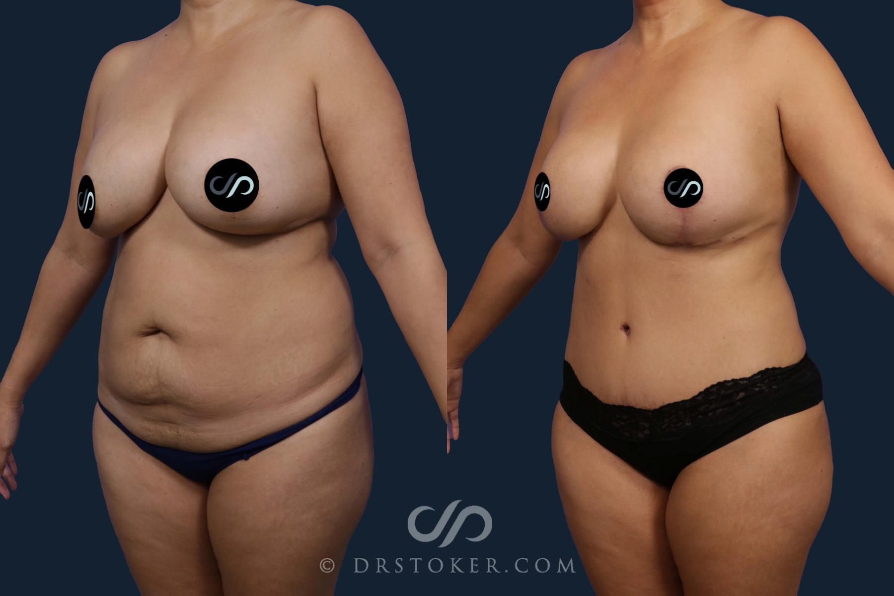 Before & After Tummy Tuck Case 2077 Left Oblique View in Los Angeles, CA