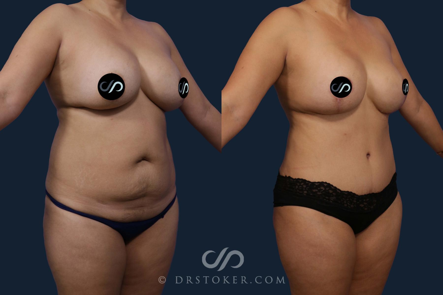Before & After Mommy Makeover Case 2077 Right Oblique View in Los Angeles, CA