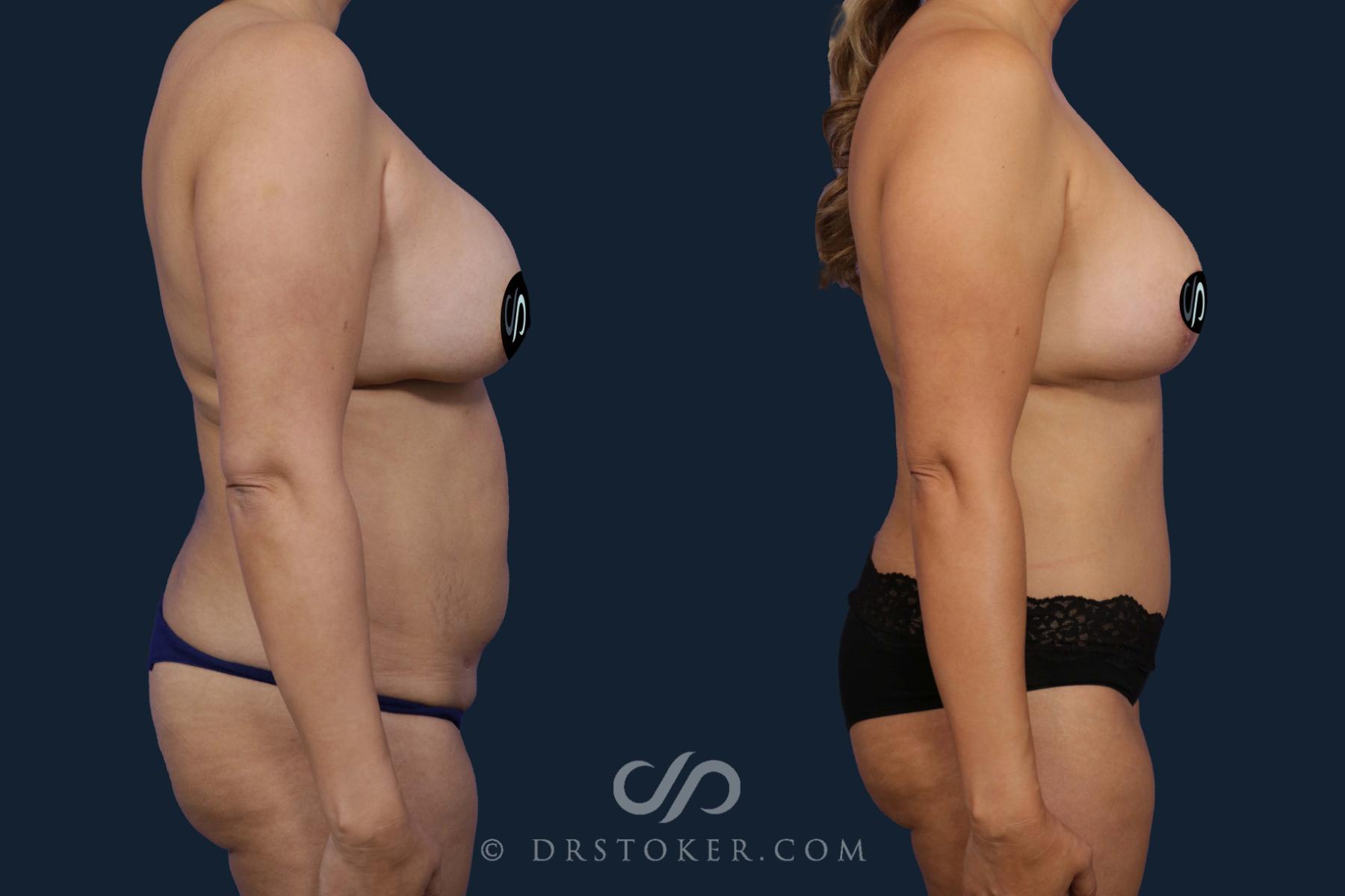 Before & After Tummy Tuck Case 2077 Right Side View in Los Angeles, CA