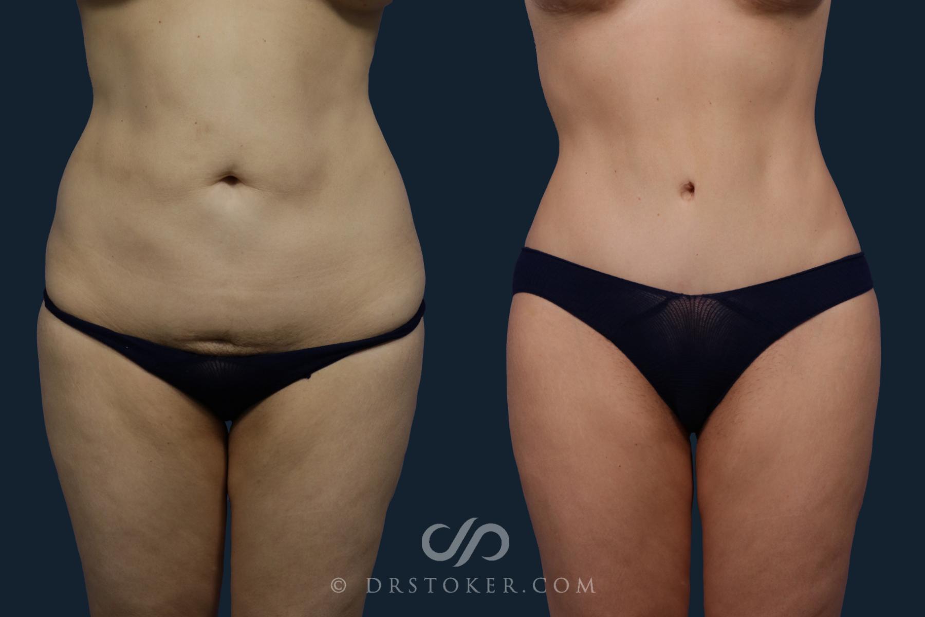 Before & After Tummy Tuck Case 2080 Front View in Los Angeles, CA