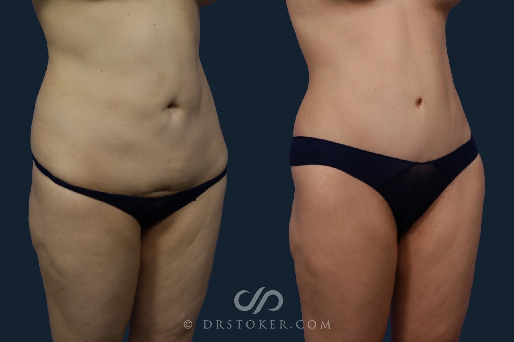 Before & After Tummy Tuck Case 2080 Right Oblique View in Los Angeles, CA
