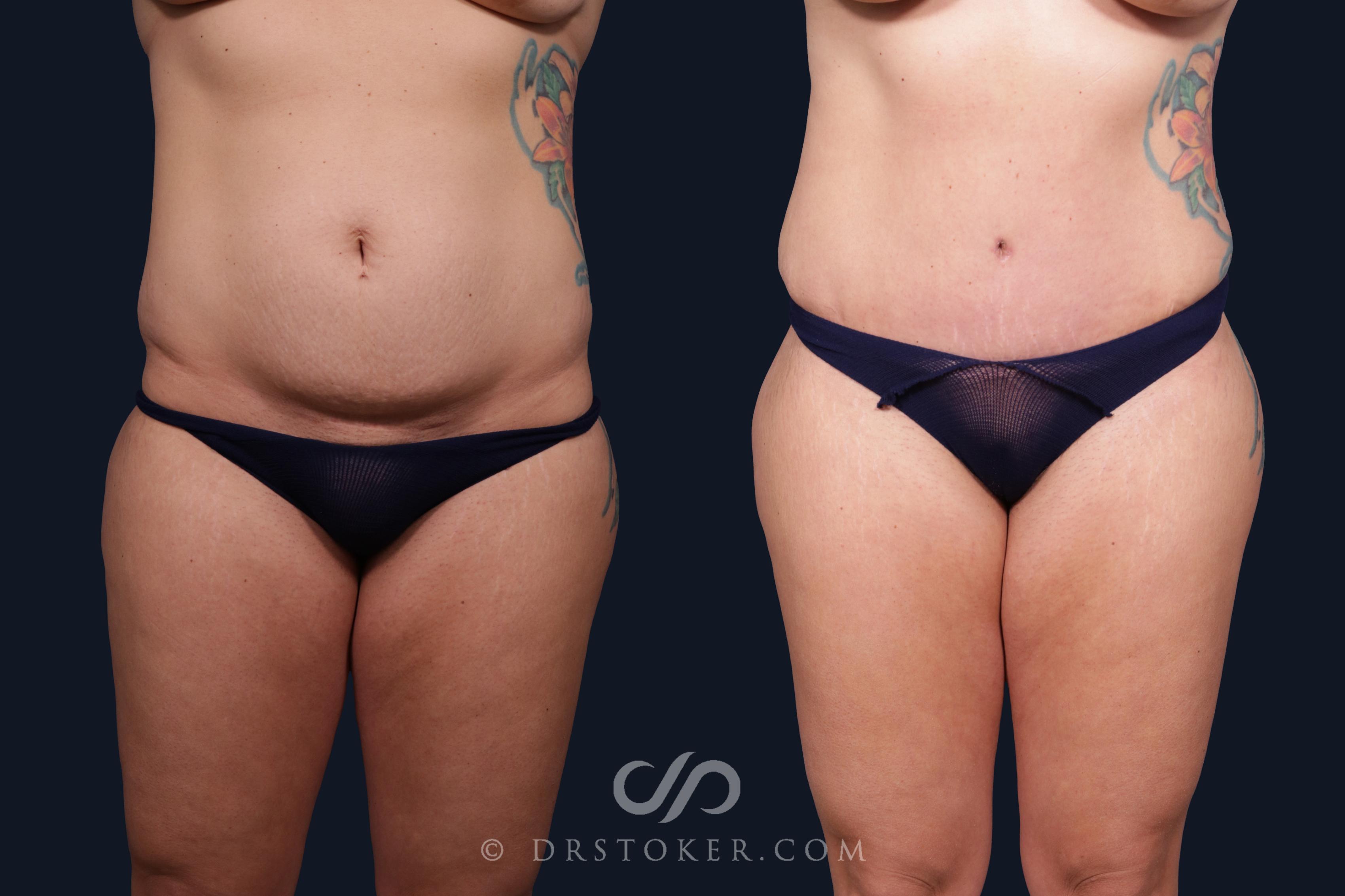 Before & After Tummy Tuck Case 2089 Front View in Los Angeles, CA