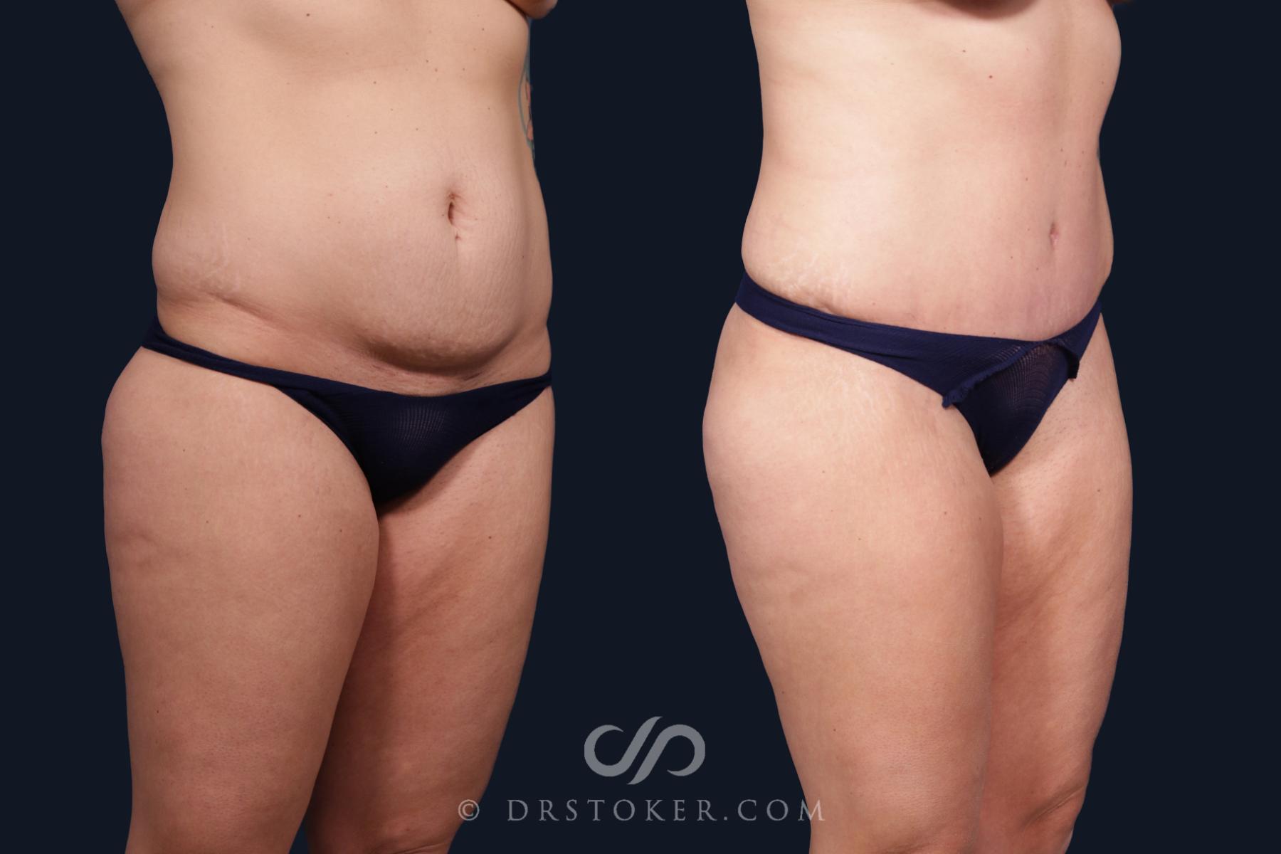 Before & After Tummy Tuck Case 2089 Right Oblique View in Los Angeles, CA