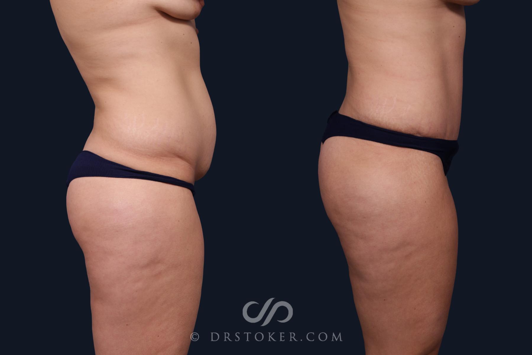 Before & After Tummy Tuck Case 2089 Right Side View in Los Angeles, CA