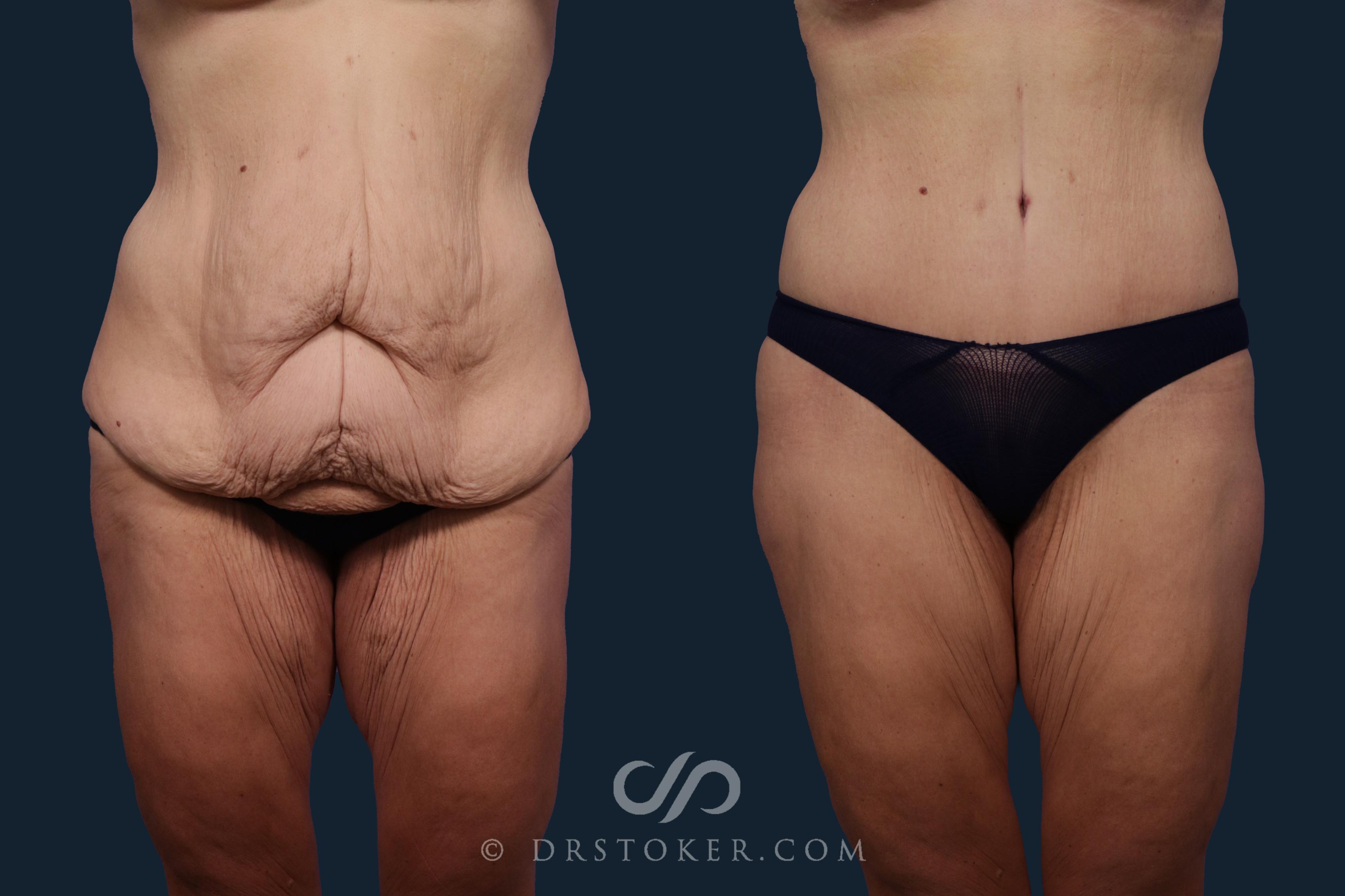 Before & After Body Lift Case 2093 Front View in Los Angeles, CA