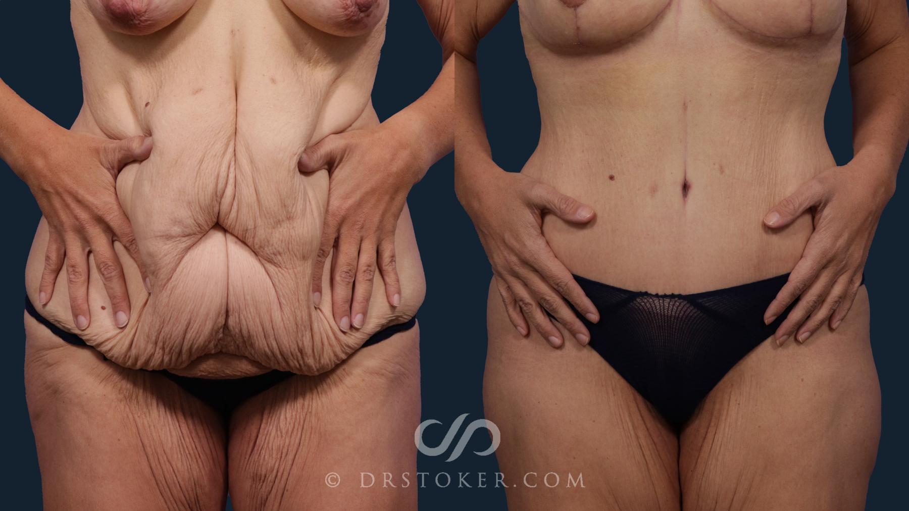 Before & After After Weight Loss Case 2093 Front Squeeze View in Los Angeles, CA