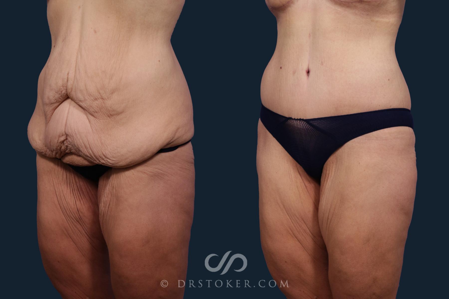Before & After Body Lift Case 2093 Left Oblique View in Los Angeles, CA