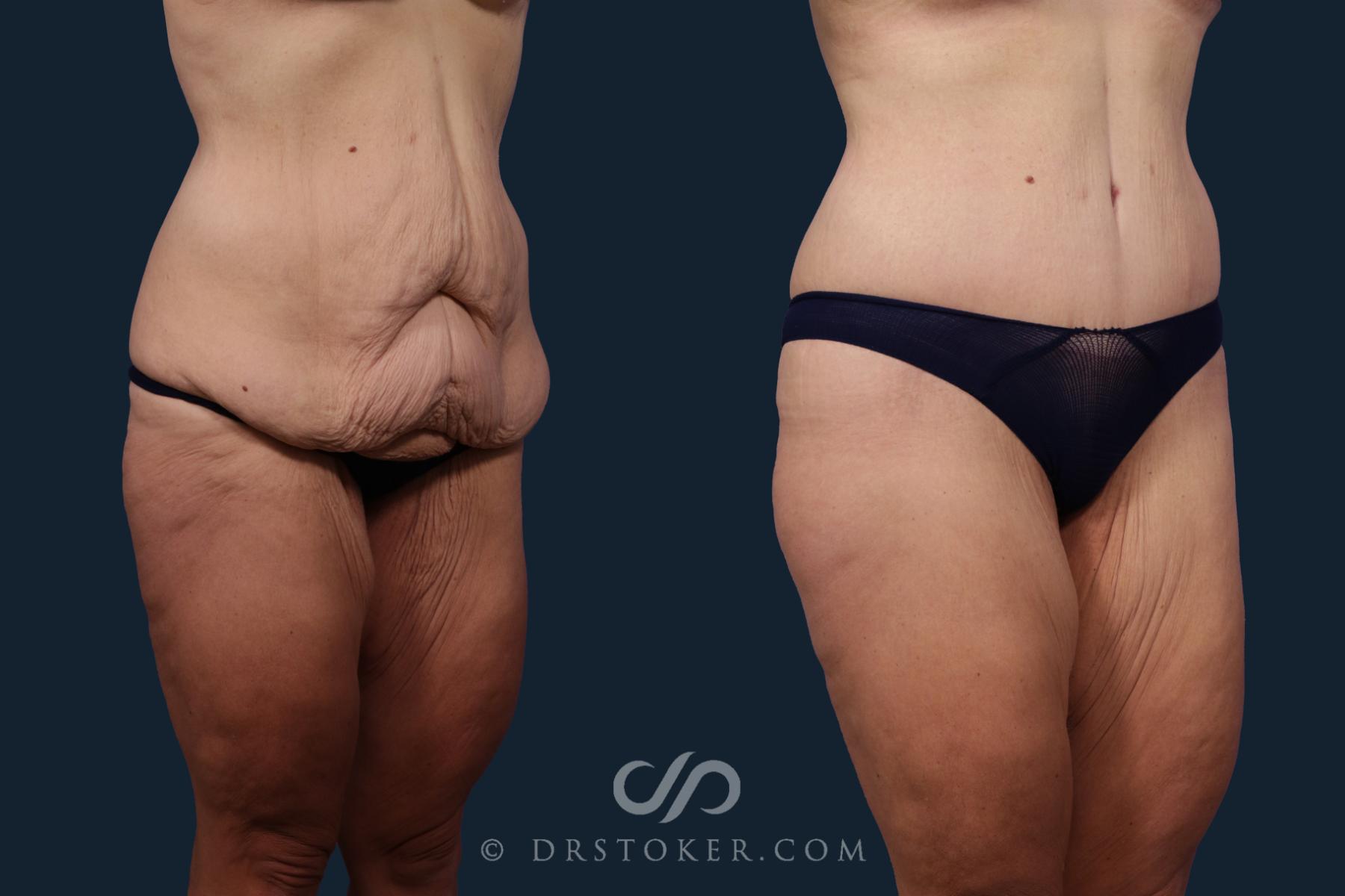 Before & After Tummy Tuck Case 2093 Right Oblique View in Los Angeles, CA